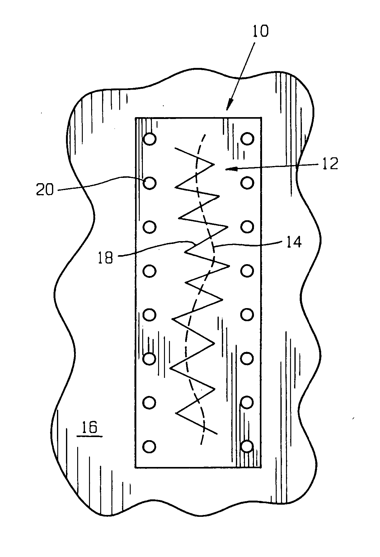 Surgical method and composition utilizing submucosal tissue to prevent incisional hernias