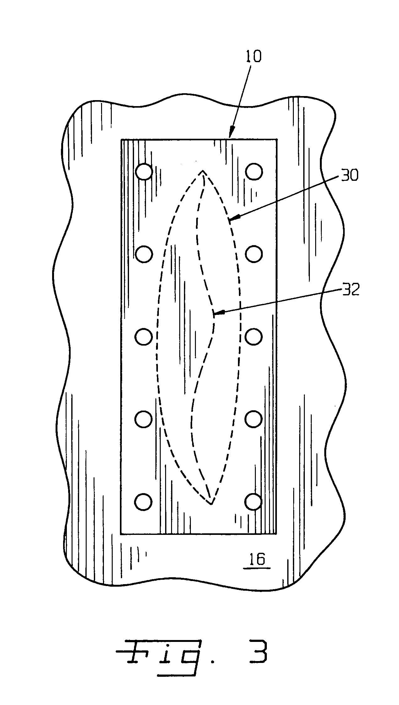 Surgical method and composition utilizing submucosal tissue to prevent incisional hernias