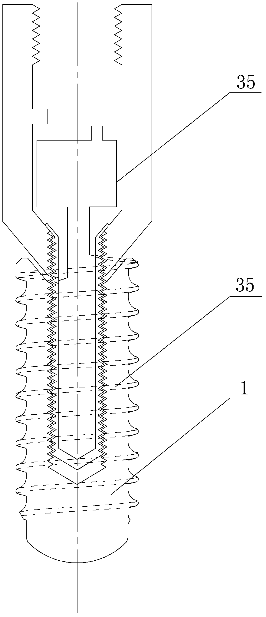 Electromagnetic stimulation dental implantation device