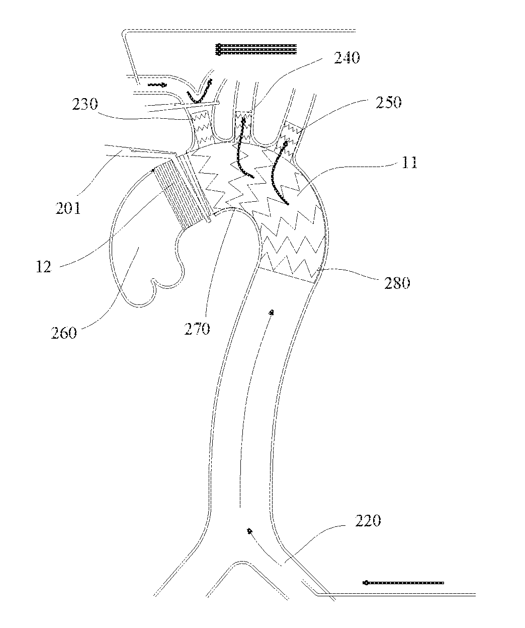 Method for treating aortic arch diseases