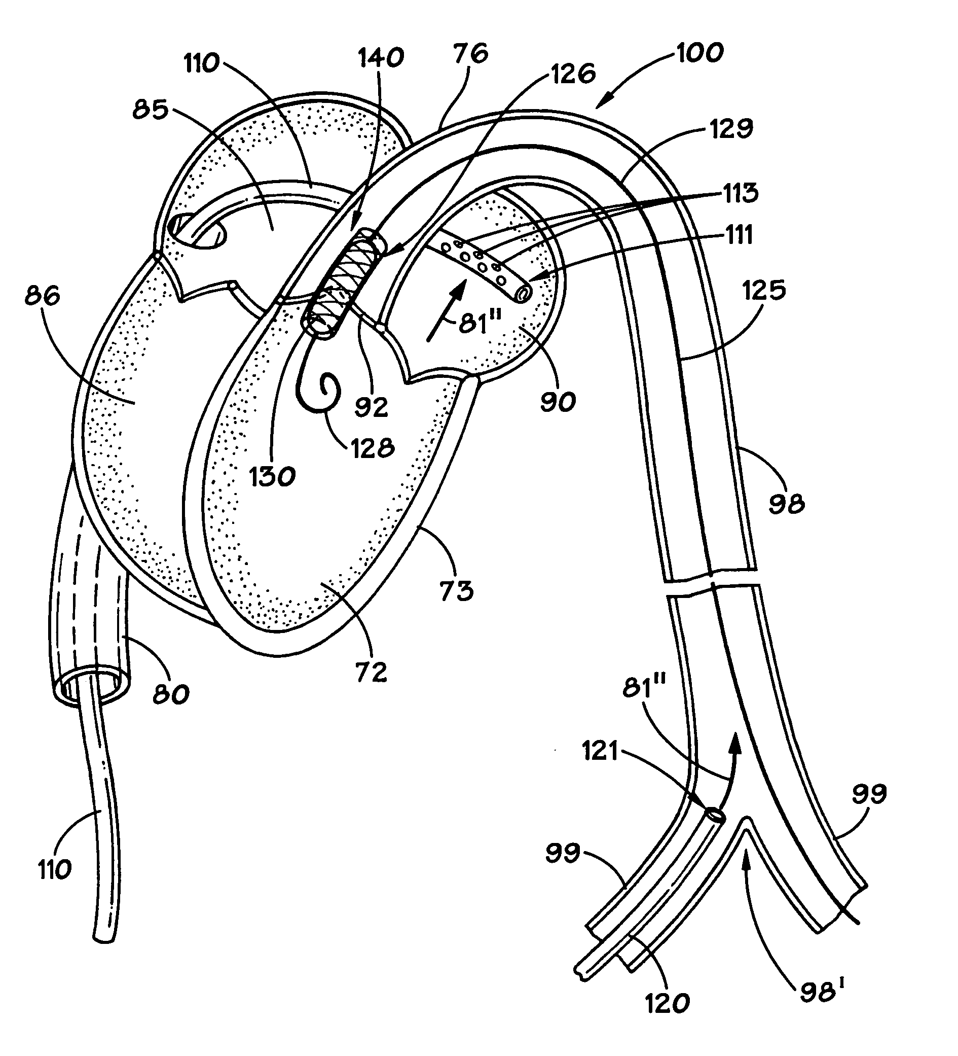 Method and apparatus for implanting an aortic valve prosthesis