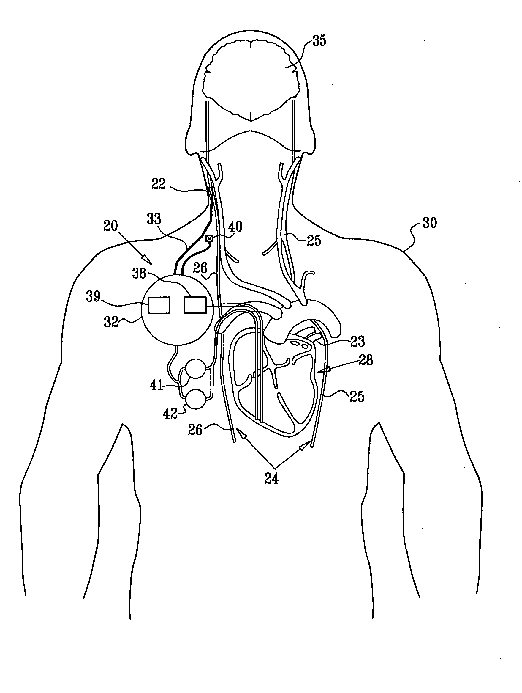 Techniques for prevention of atrial fibrillation