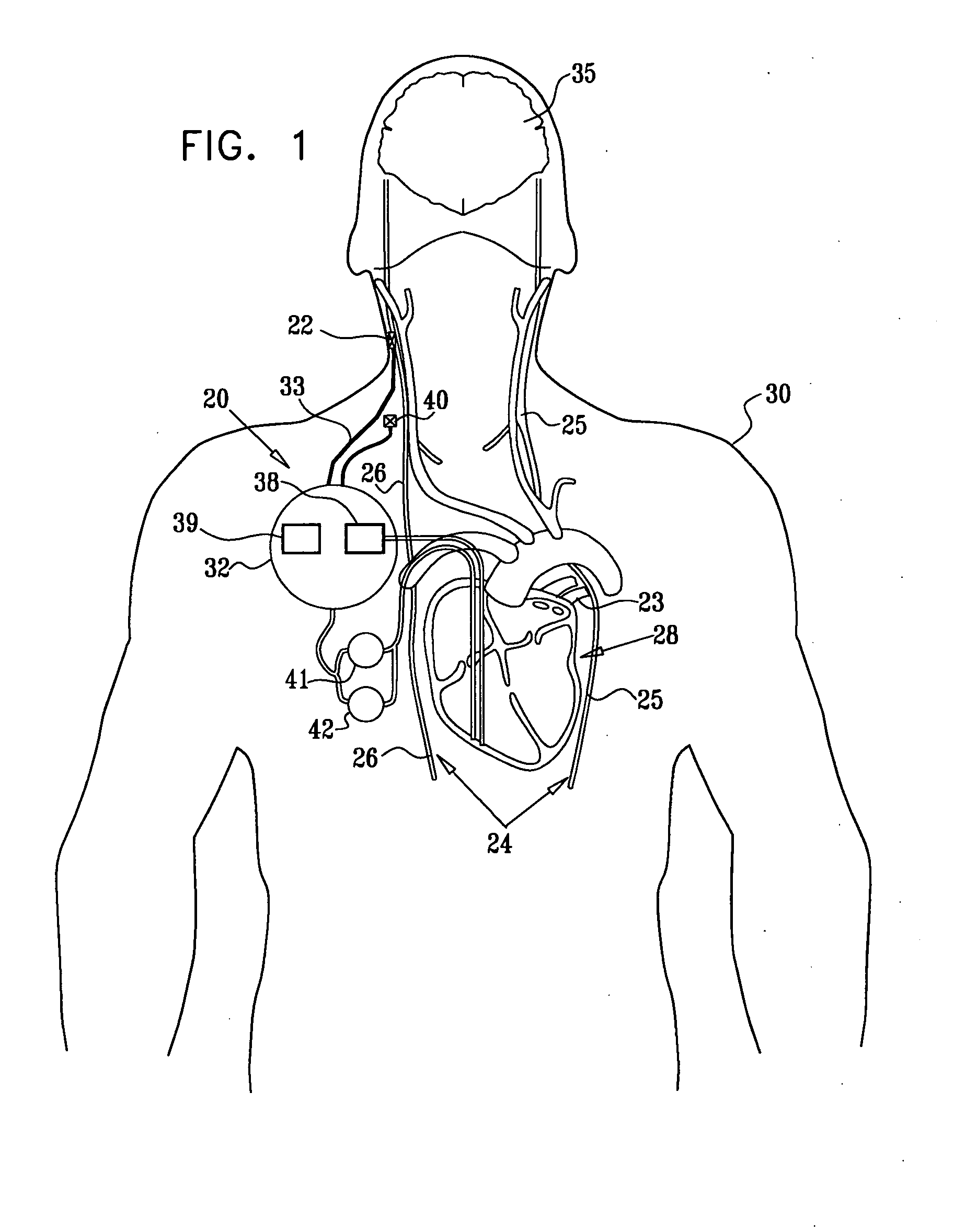 Techniques for prevention of atrial fibrillation