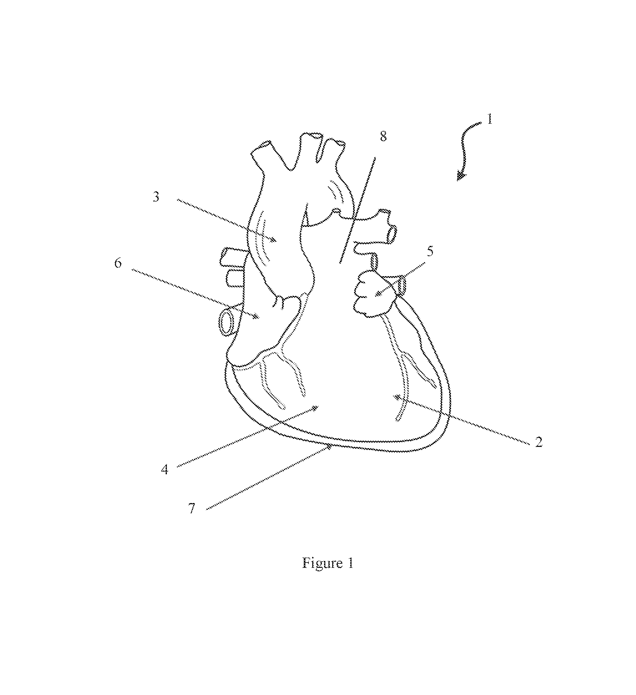 Epicardial Heart Rhythm Management Devices, Systems and Methods