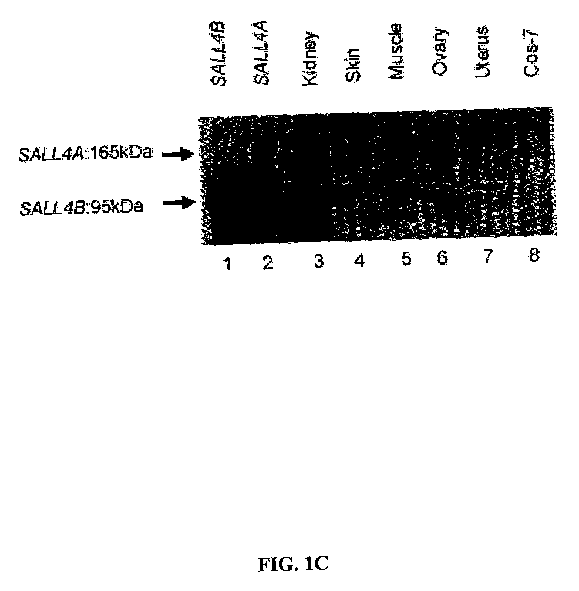 Targeting of SALL4 for the treatment and diagnosis of proliferative disorders associated with myelodysplastic syndrome (MDS)