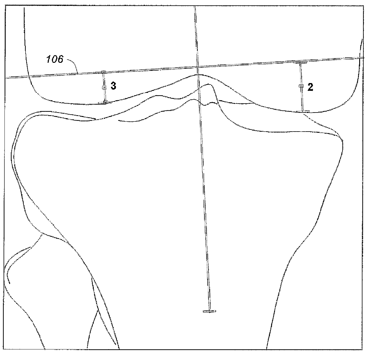 Bony balancing apparatus and method for total knee replacement