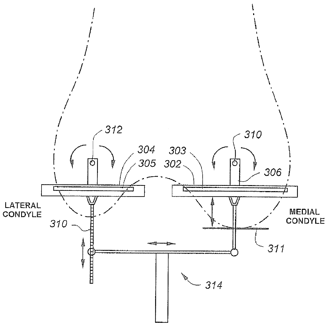 Bony balancing apparatus and method for total knee replacement