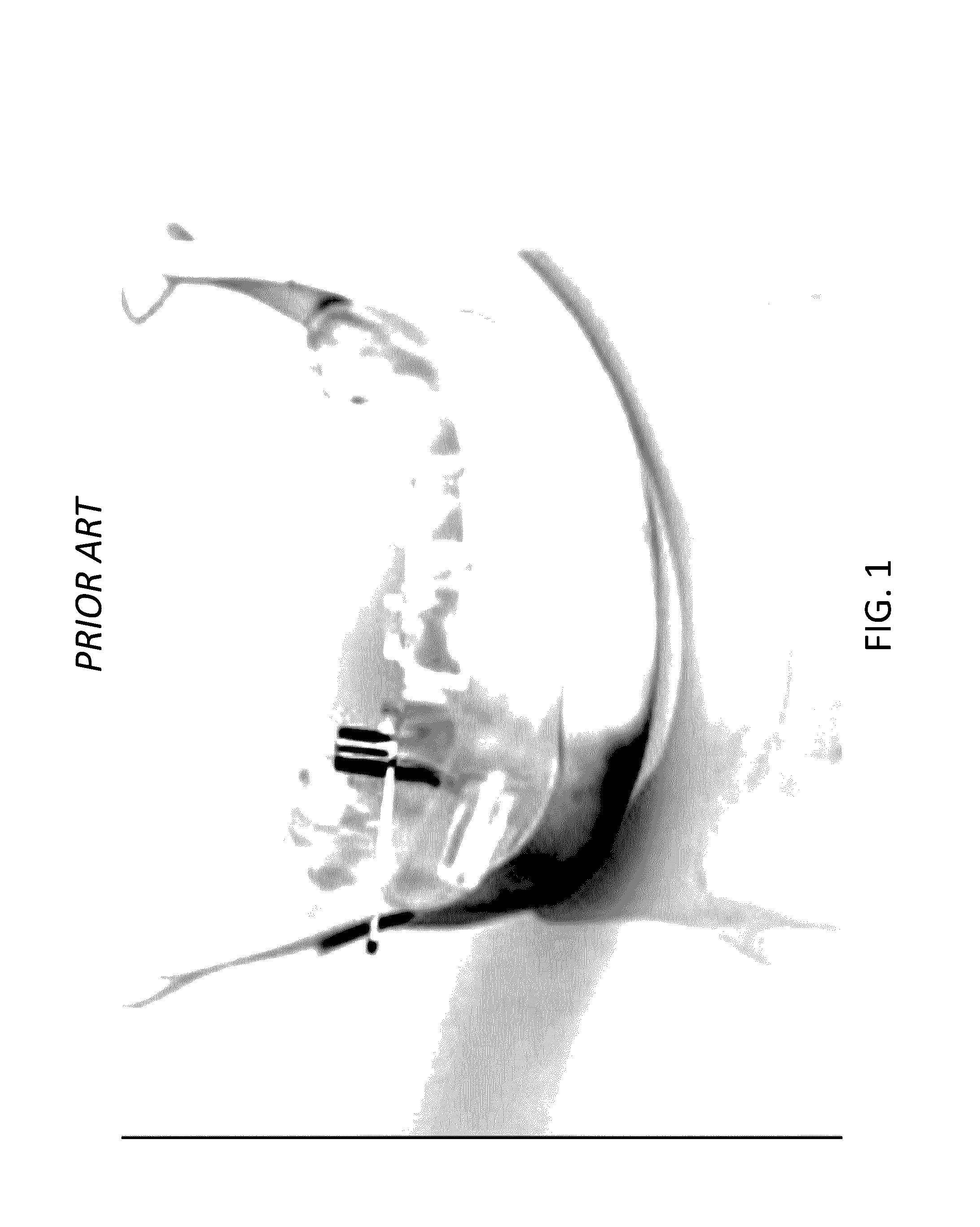 Sequential dental surgical guide system and related methods