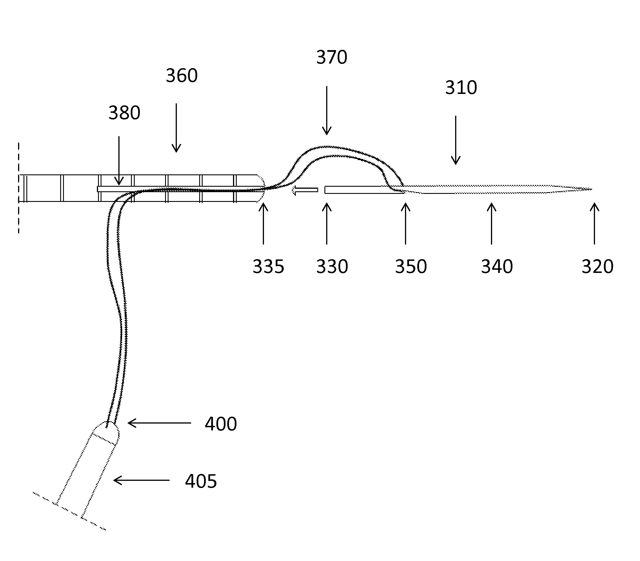 Locking needle for inflatable penile prosthesis