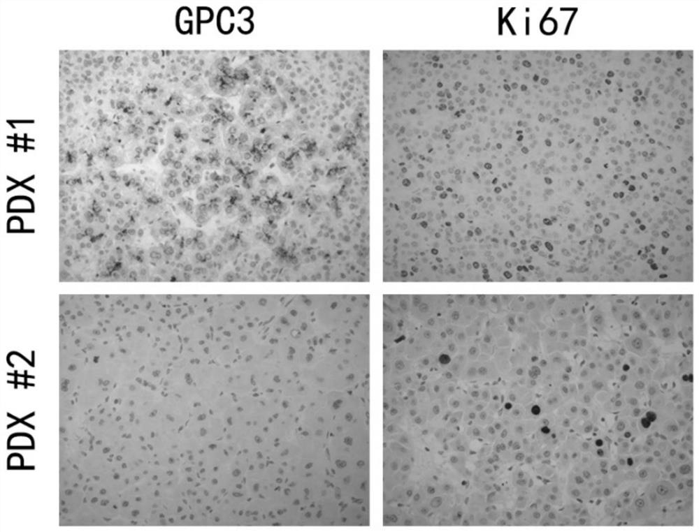 A method for constructing a PDX model of hepatocellular carcinoma