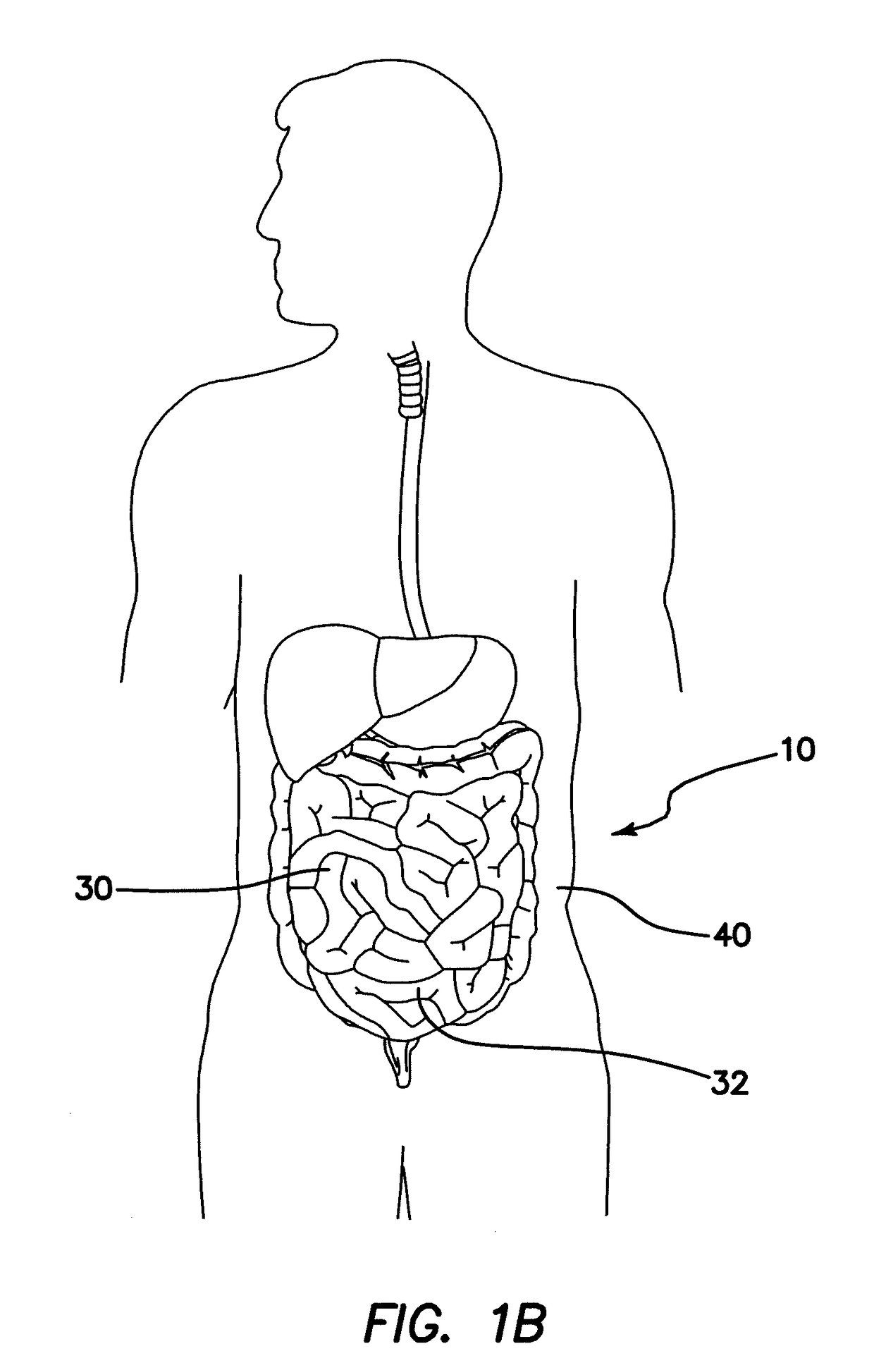 Surgical access device comprising internal retractor