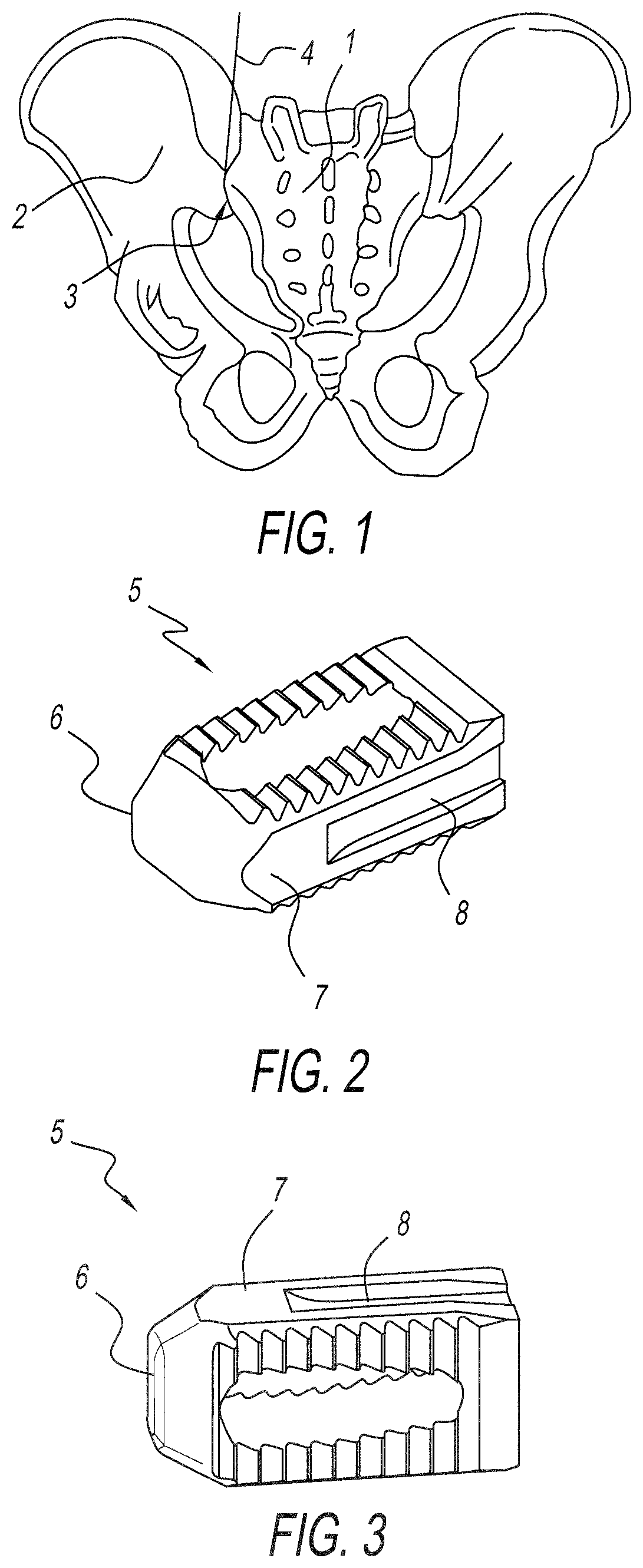 Allograft implant for fusing a sacroiliac joint