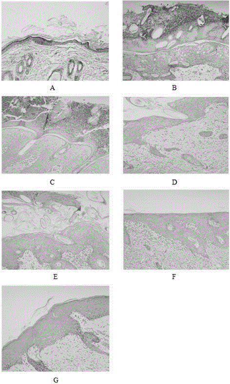 Traditional Chinese medicine composition used for controlling radiothermitis and application thereof