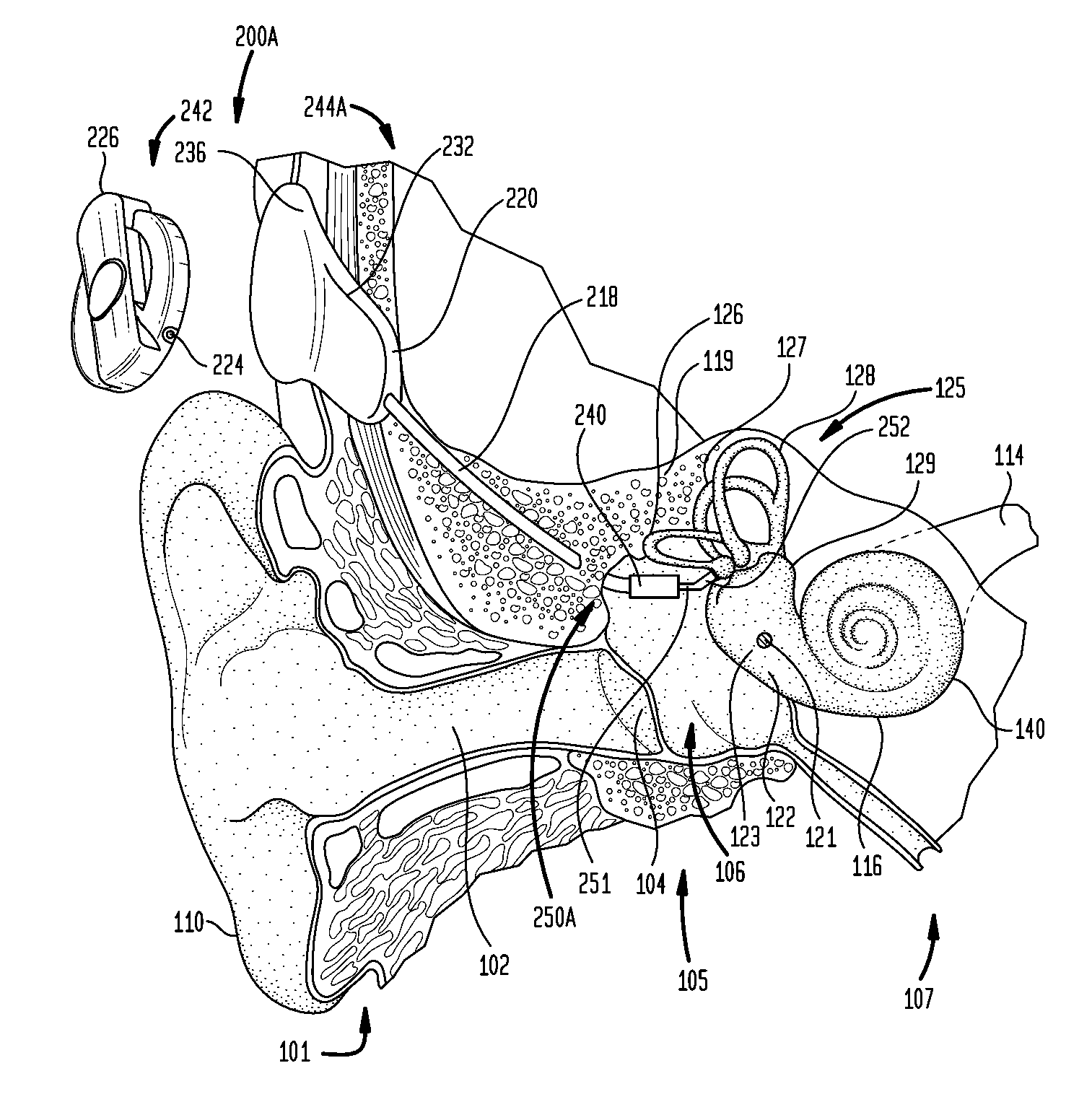 Direct acoustic cochlear stimulator for round window access