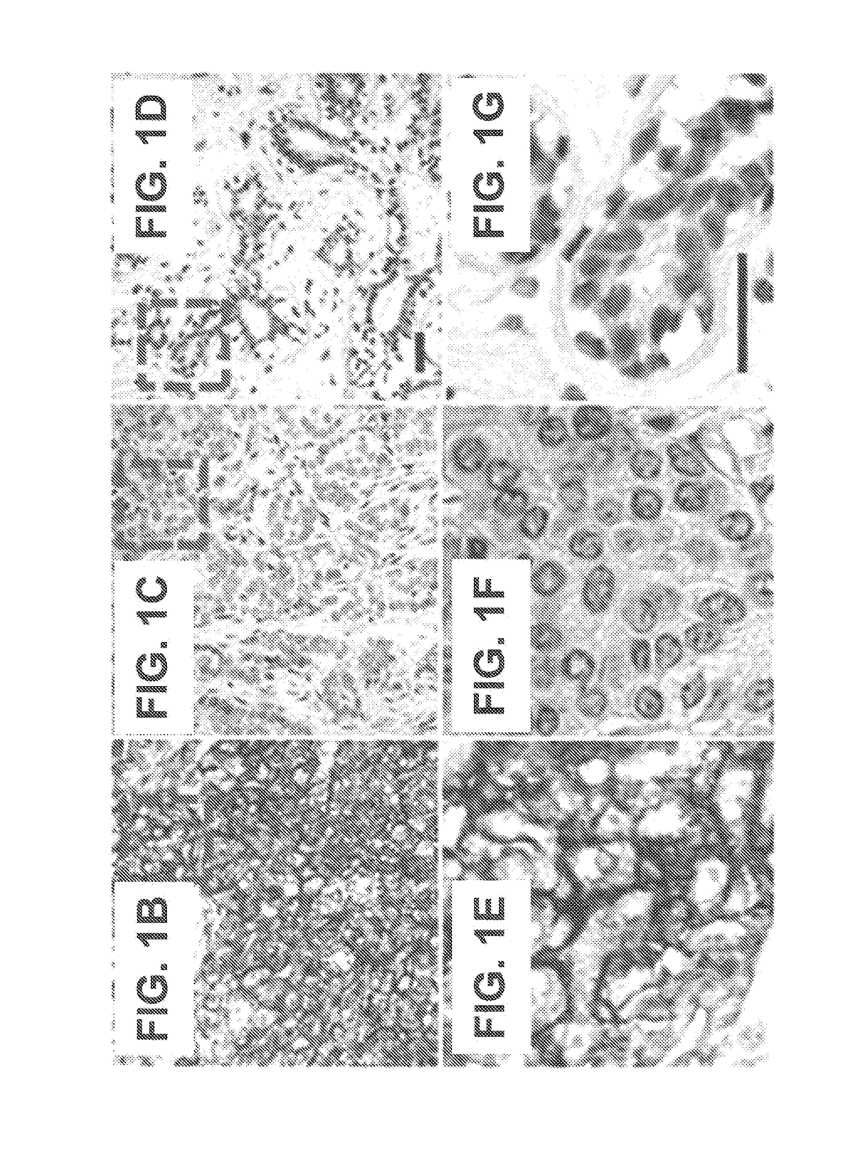 Method for detecting or treating triple negative breast cancer