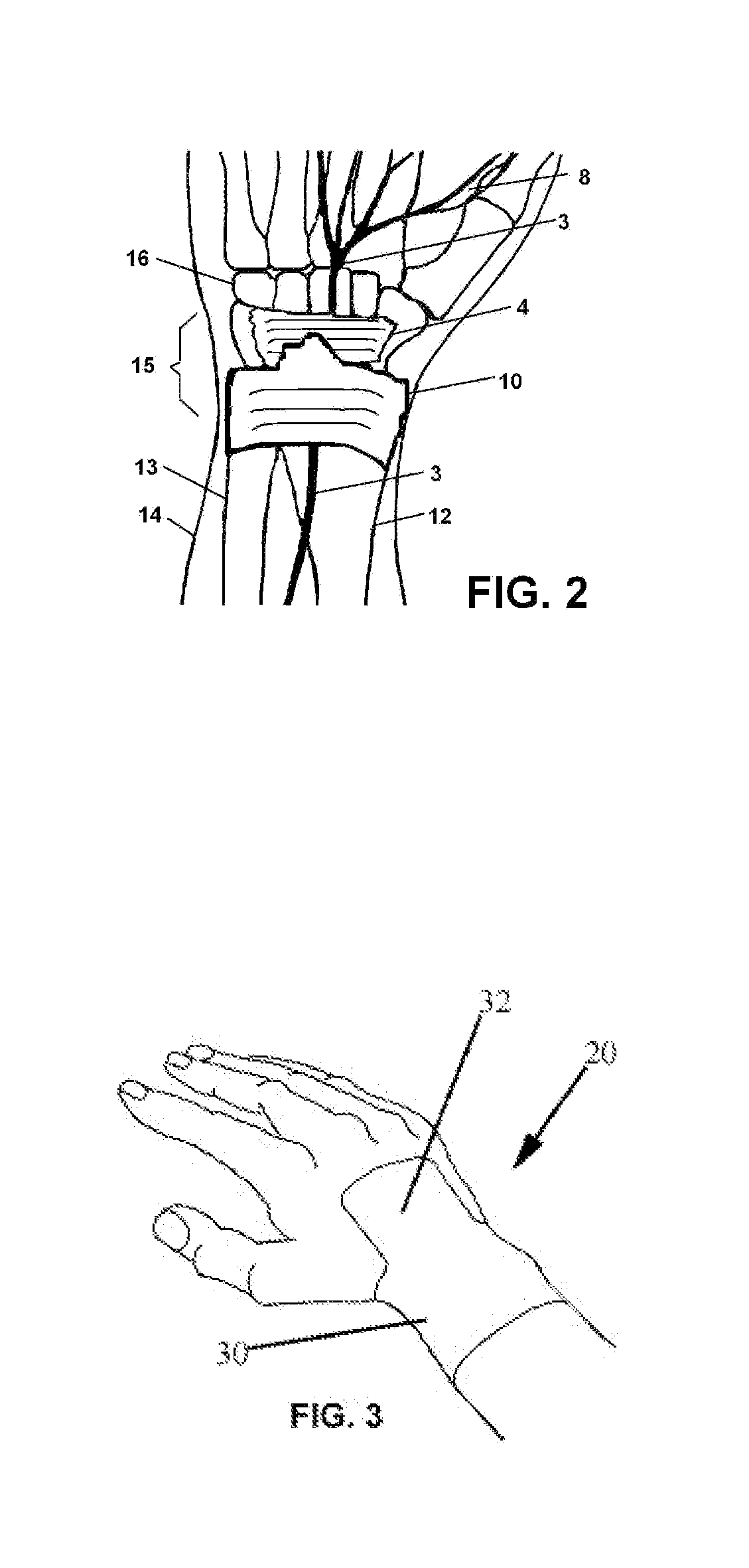 Adhesive Wrist Support System