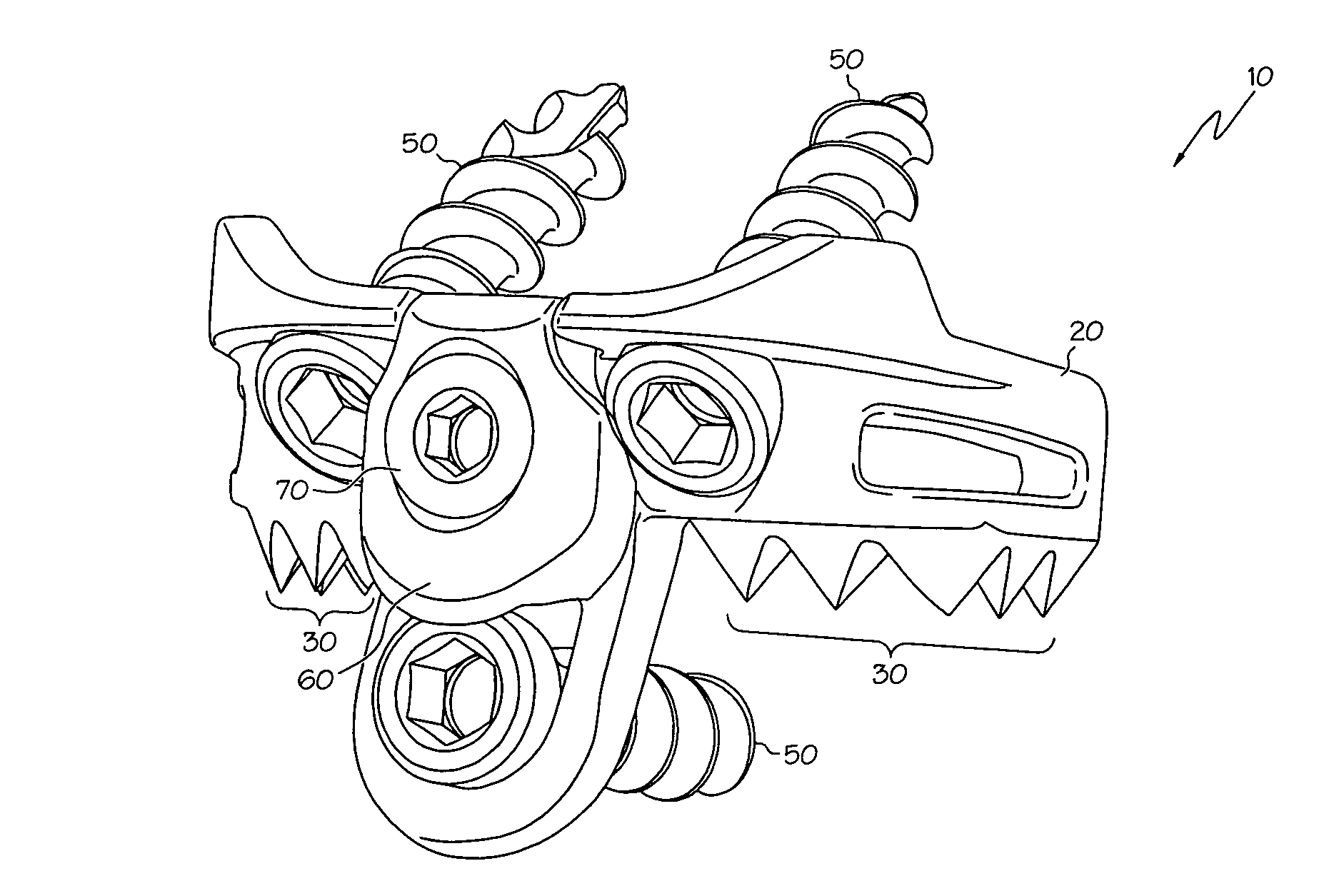 Implant subsidence control