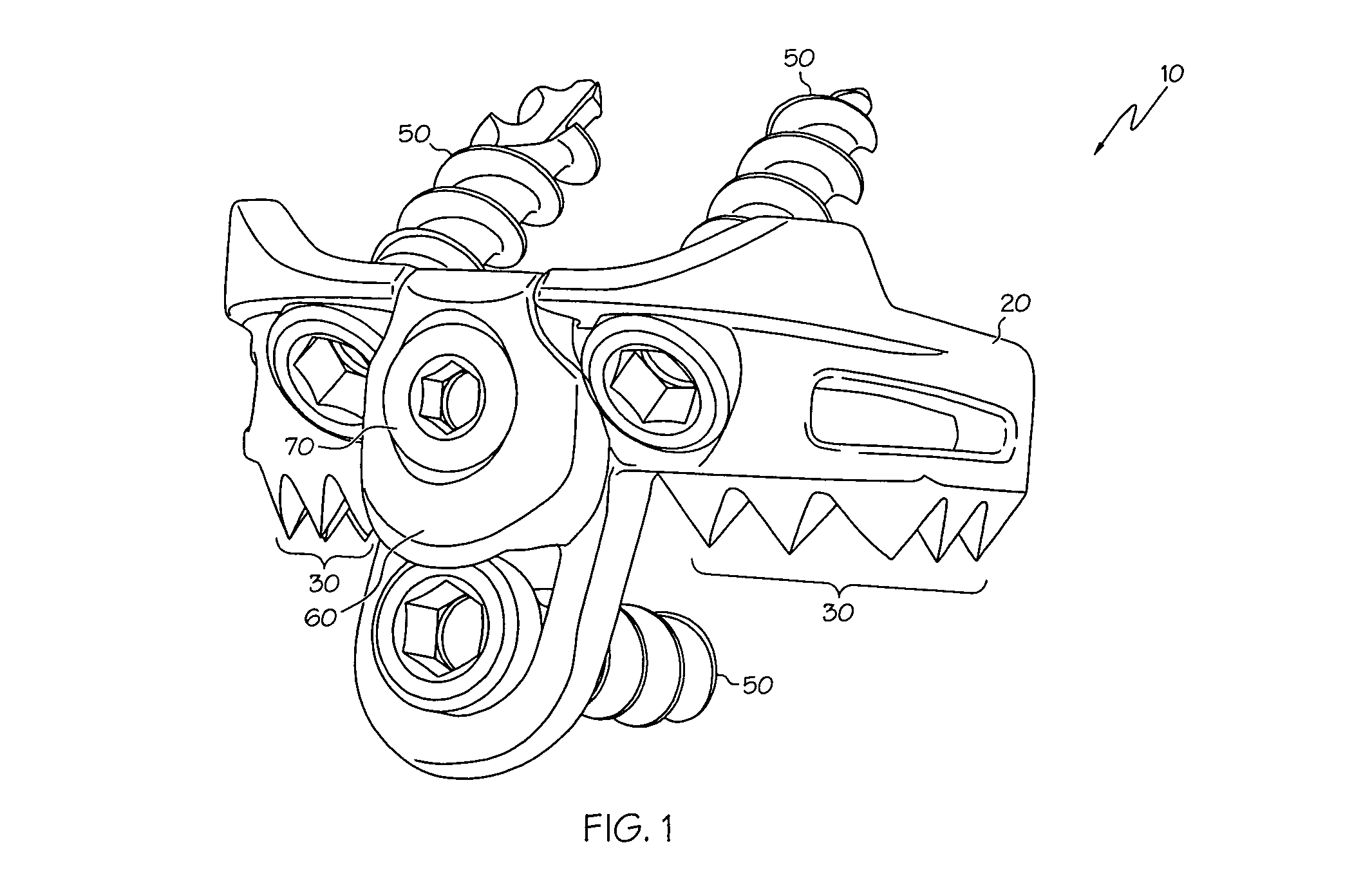 Implant subsidence control