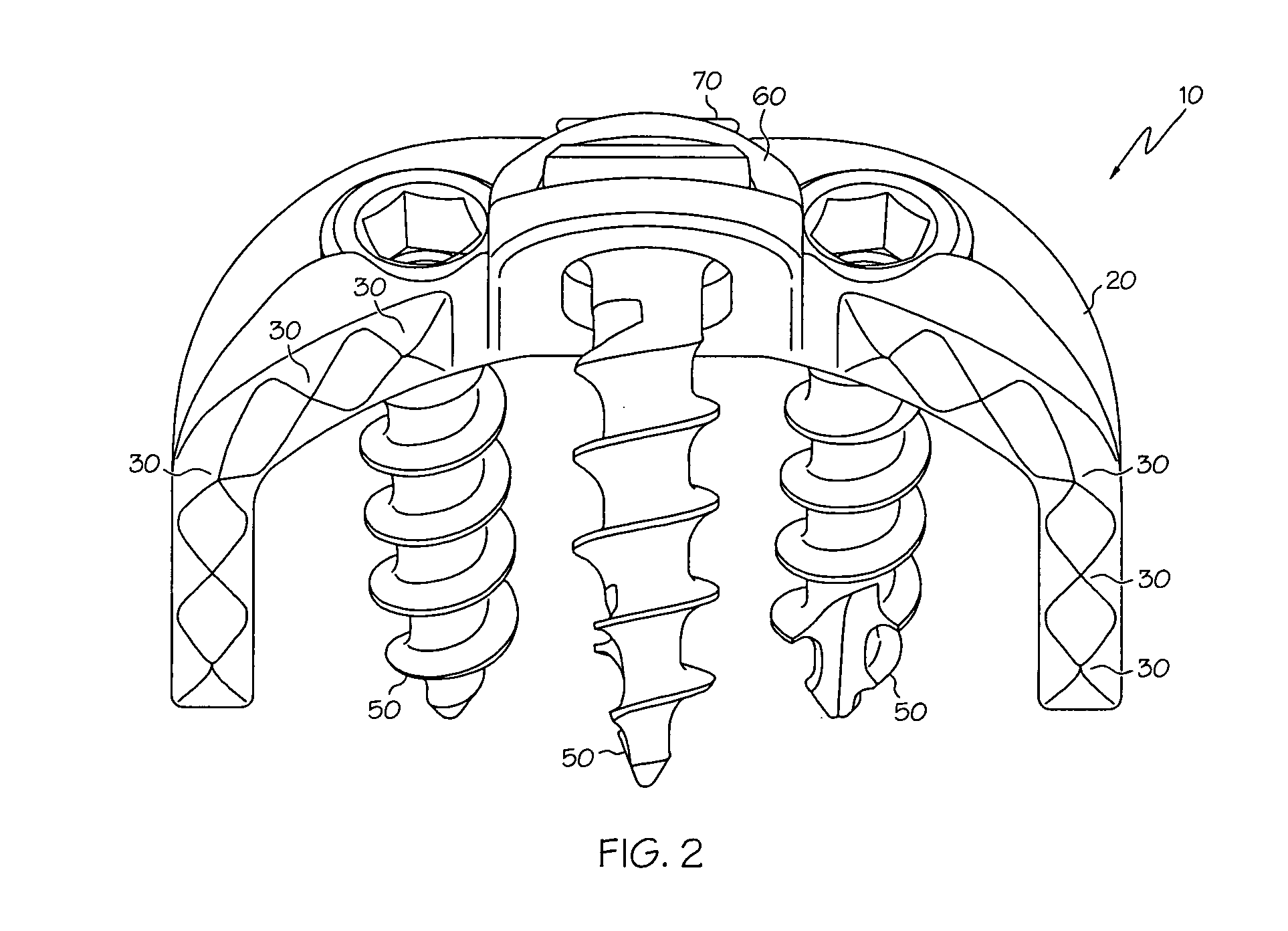 Implant subsidence control