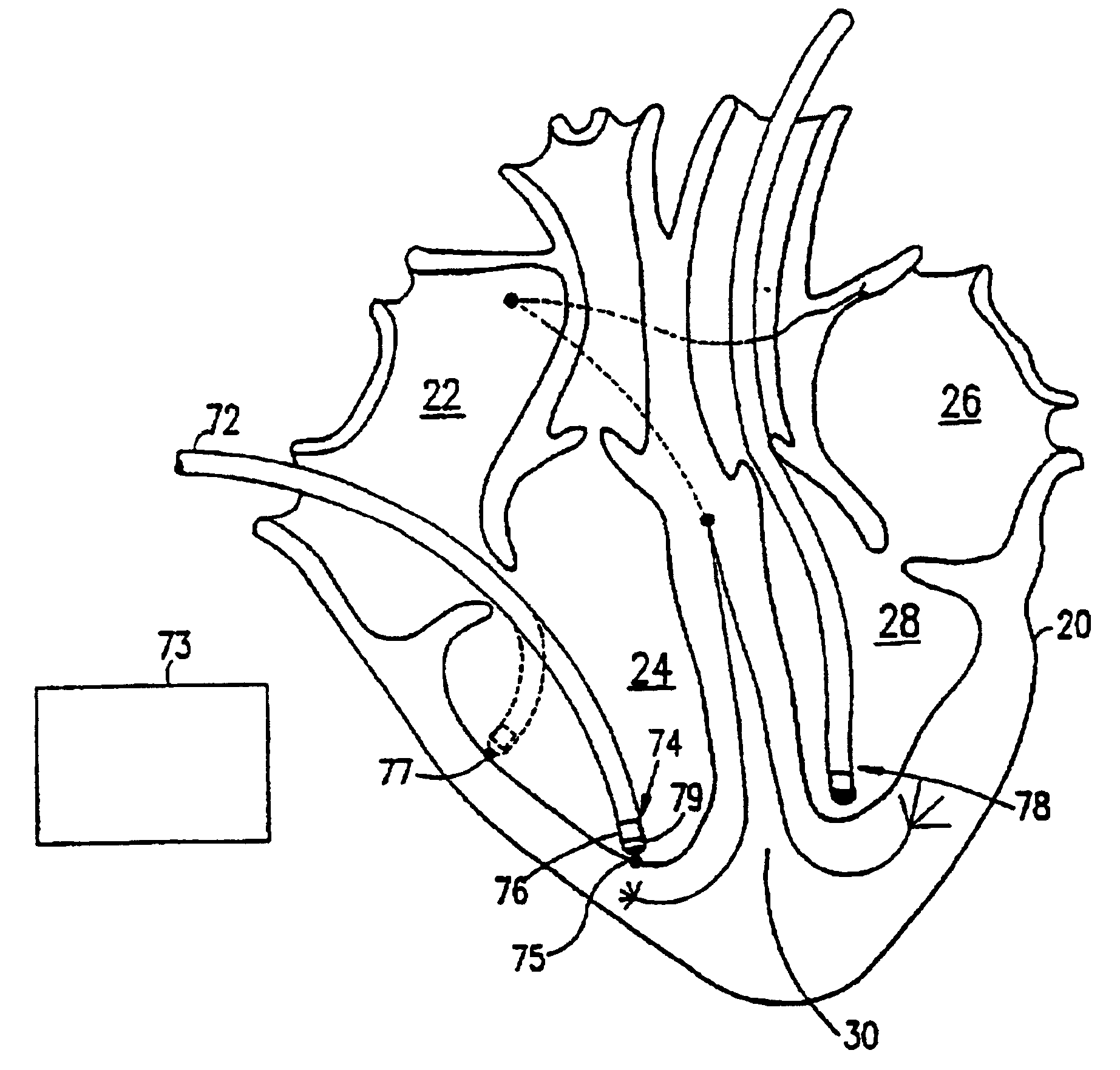Method of pacing a heart using implantable device