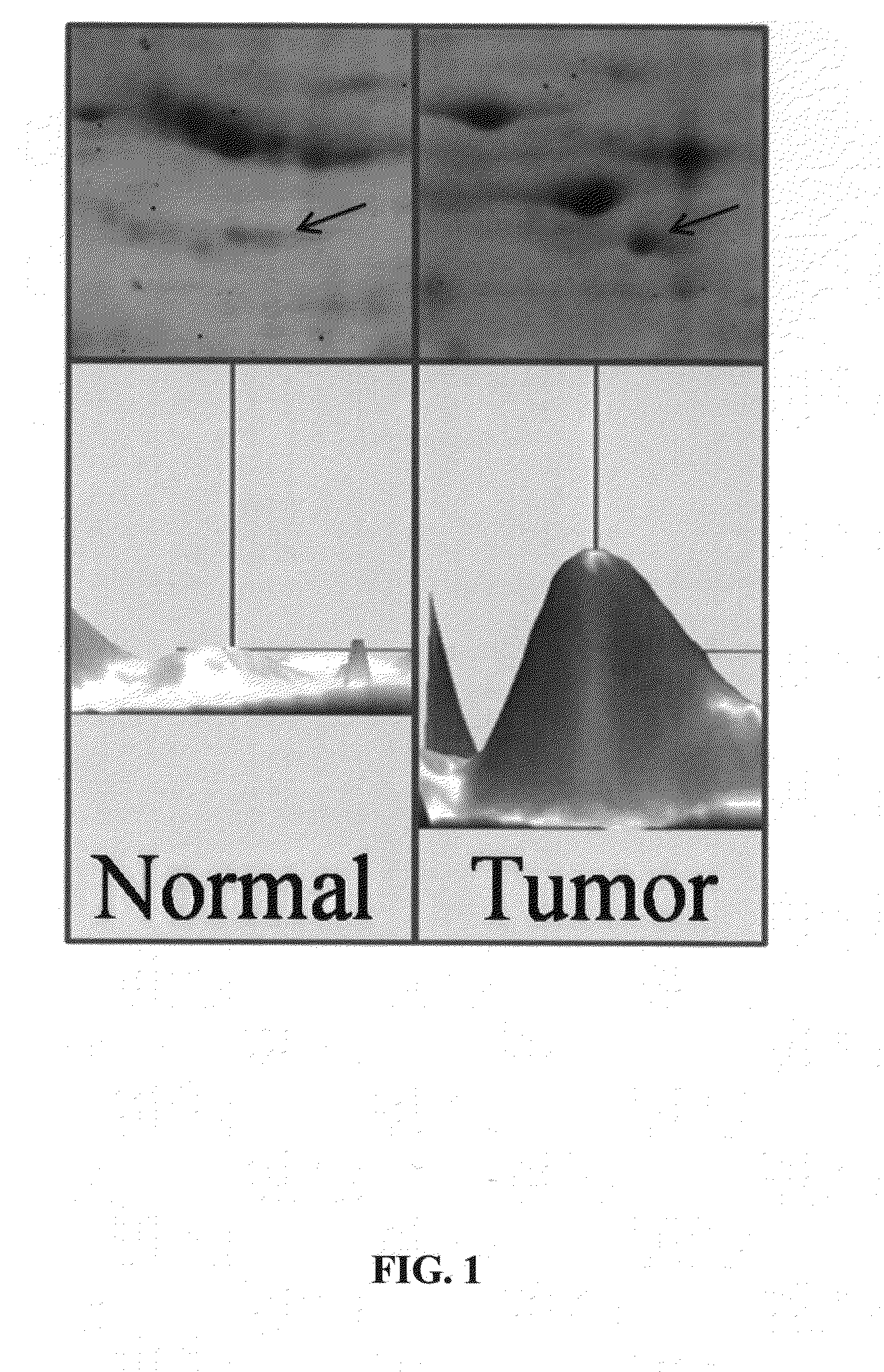 Method of treating cancer using atp synthase inhibitors