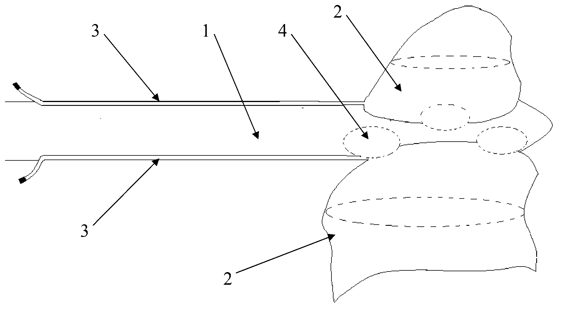 Pressurized drainage tube for chest