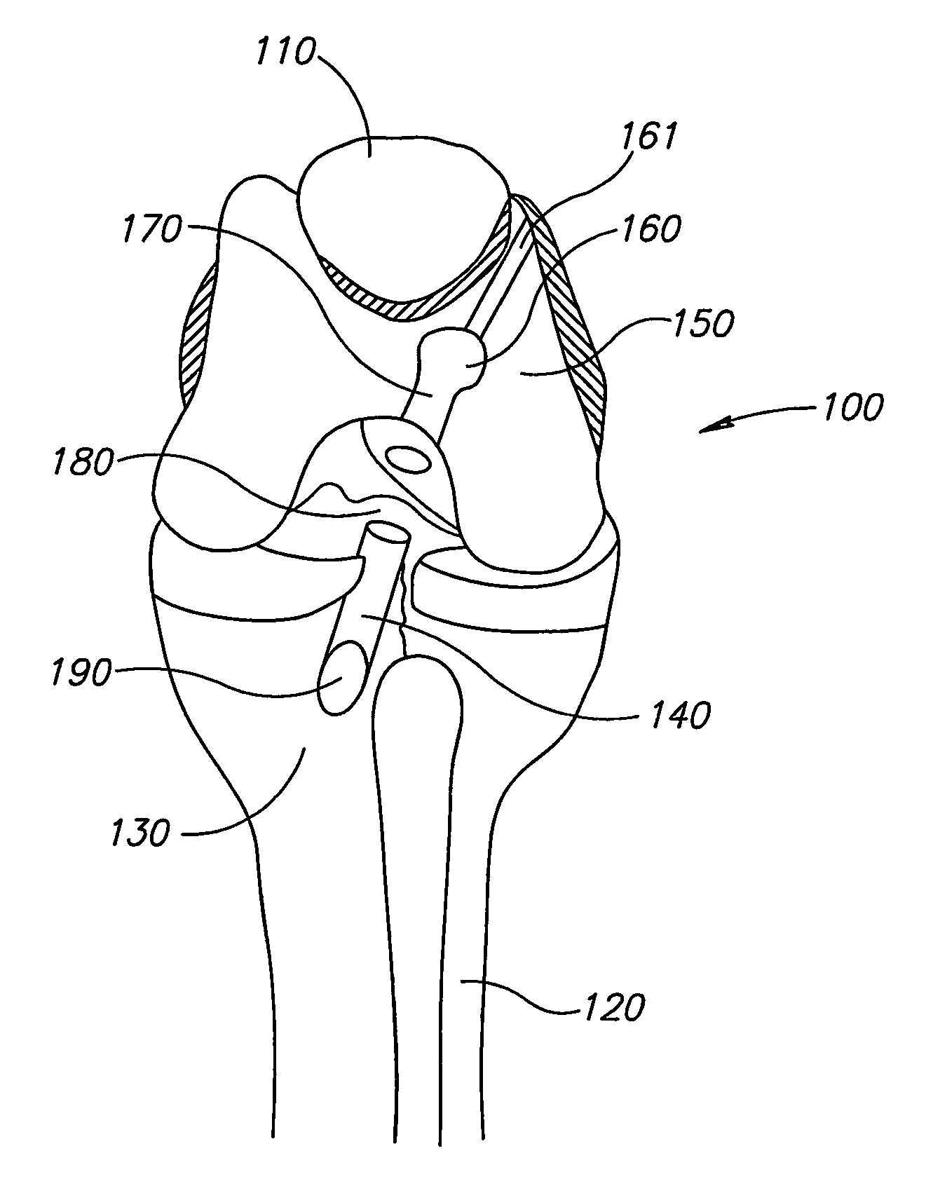 Soft Tissue to Bone Fixation