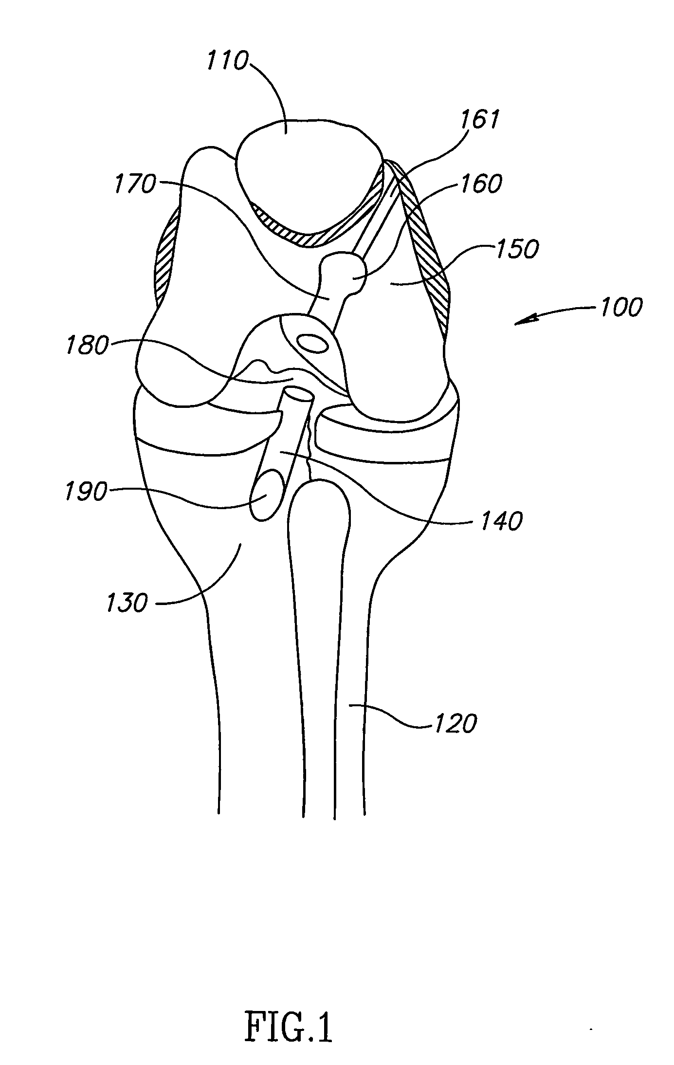 Soft Tissue to Bone Fixation