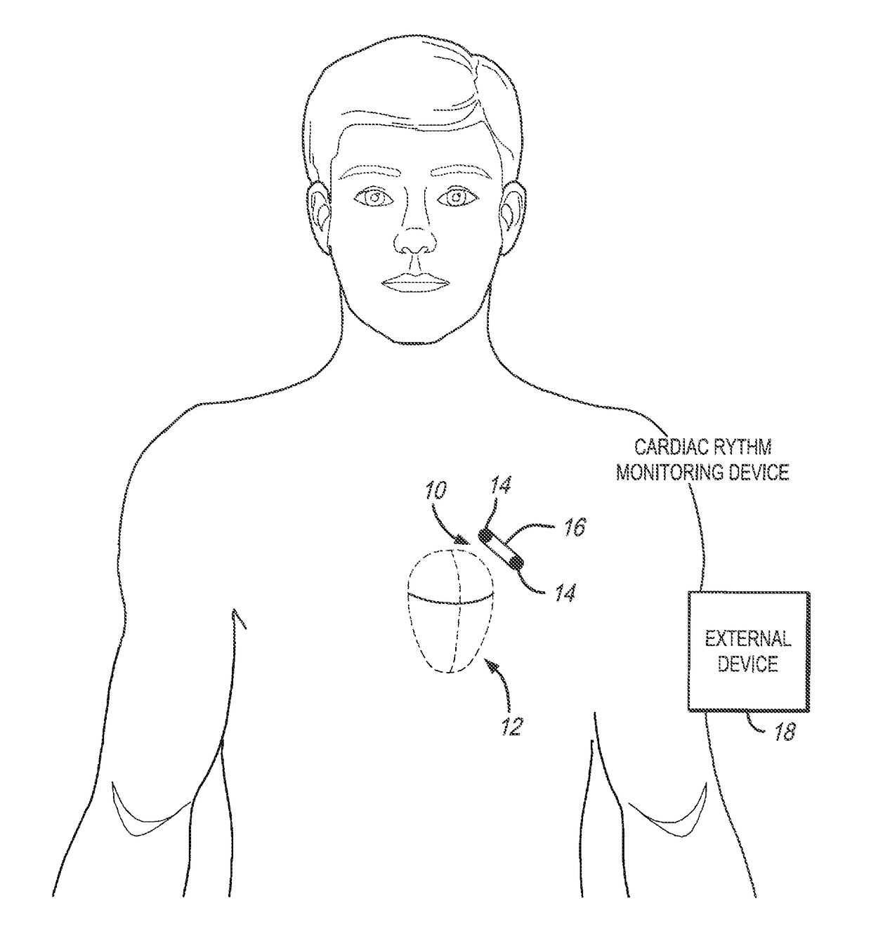 Method and system to discriminate rhythm patterns in cardiac activity