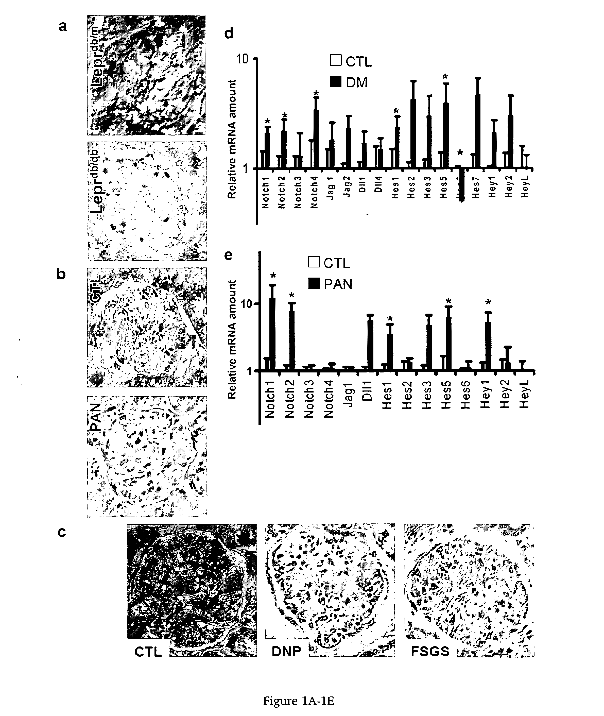 Use of gamma secretase inhibitors and notch pathway inhibitors for treatment and prevention of renal desease