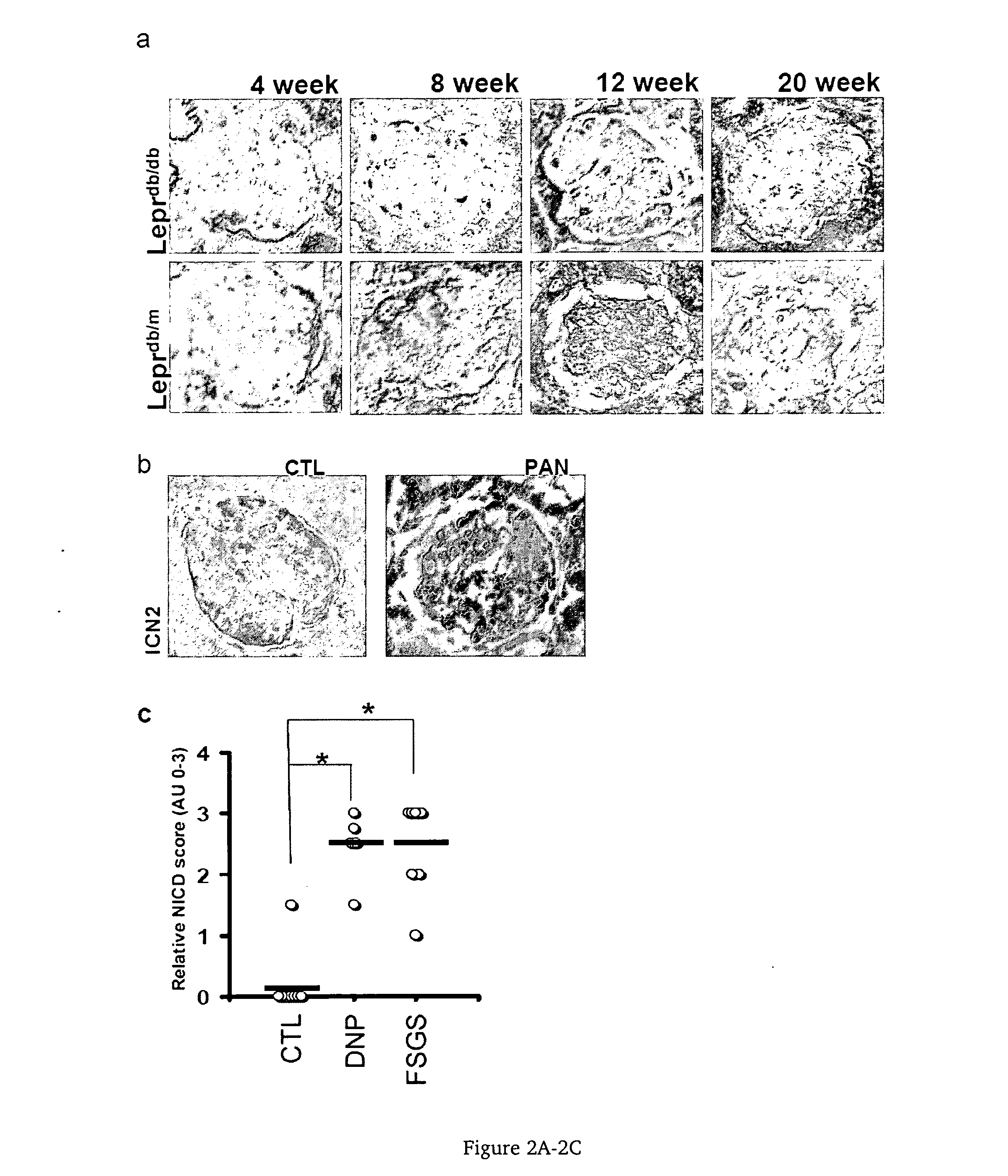 Use of gamma secretase inhibitors and notch pathway inhibitors for treatment and prevention of renal desease