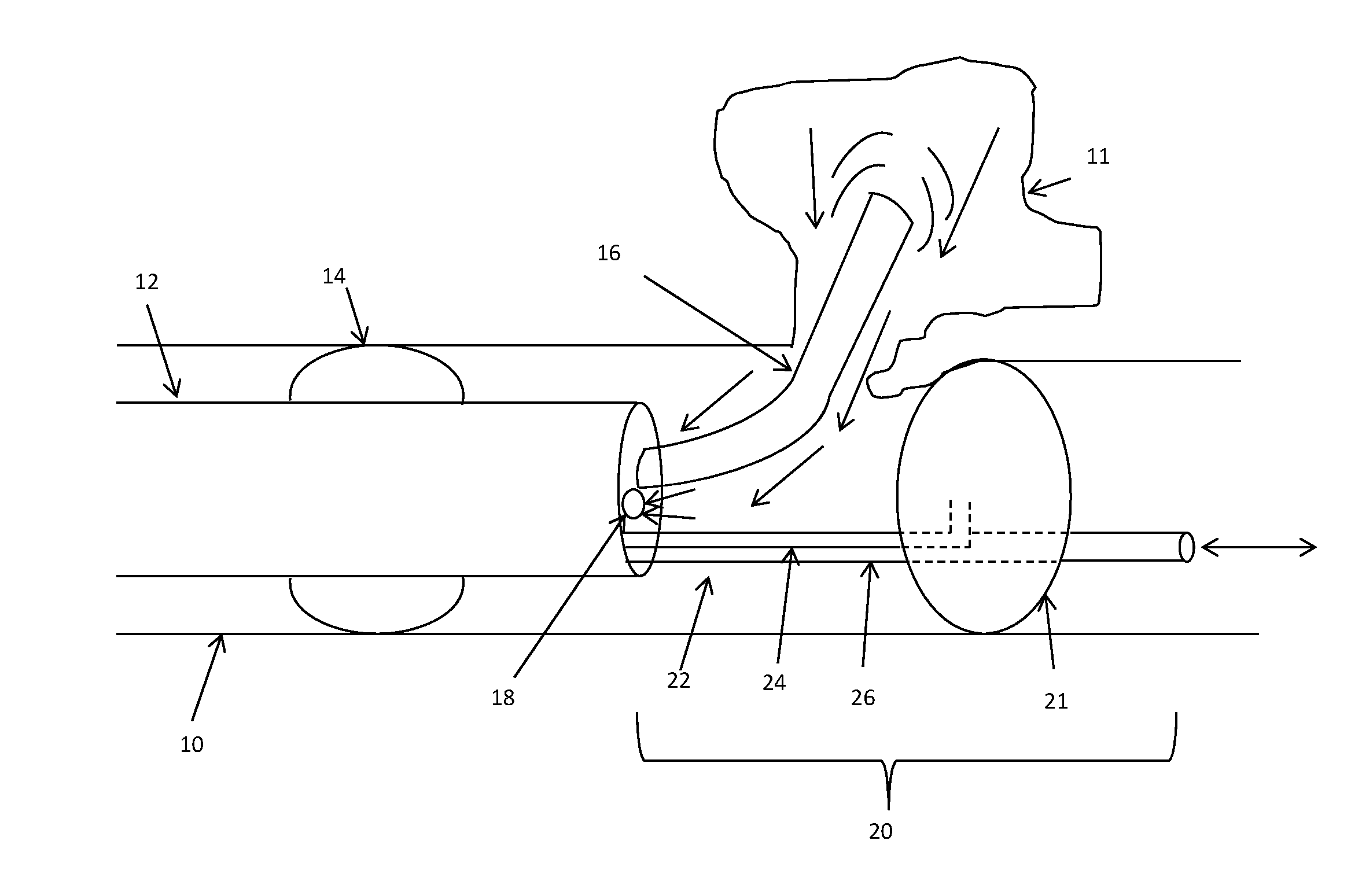 System and method for treating COPD and emphysema