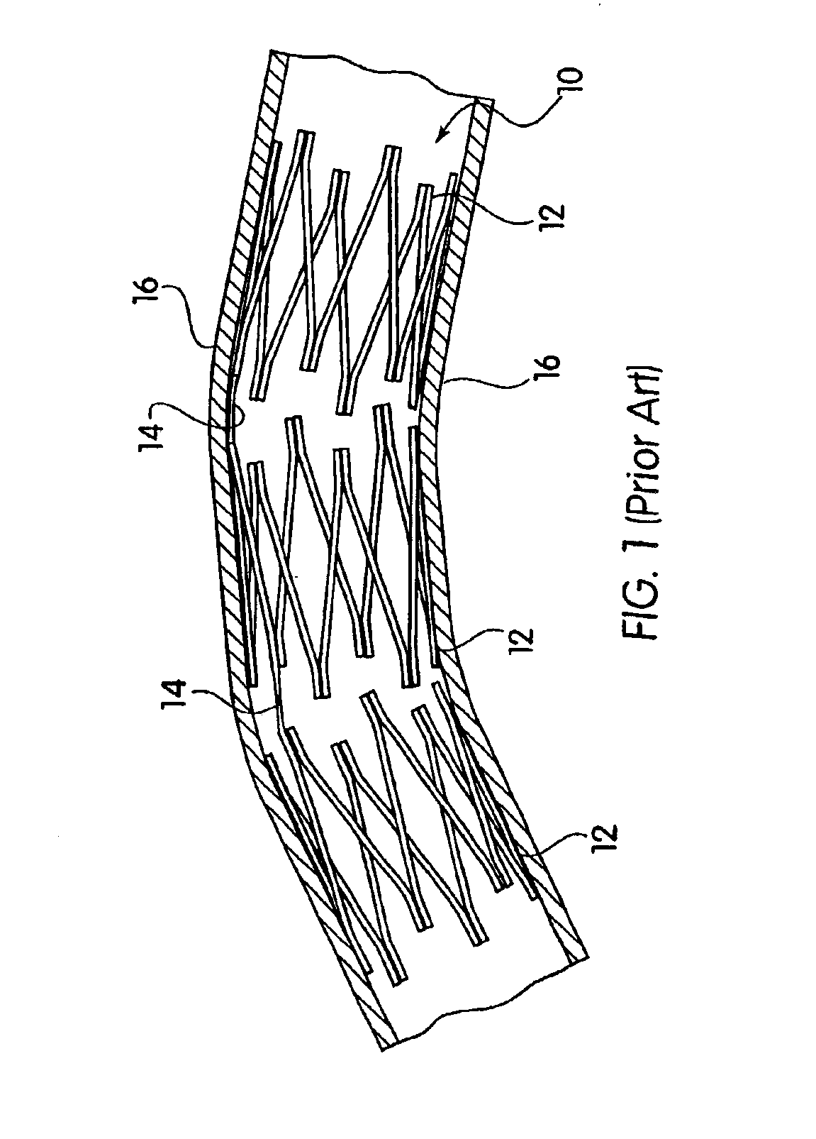 Articulated stent