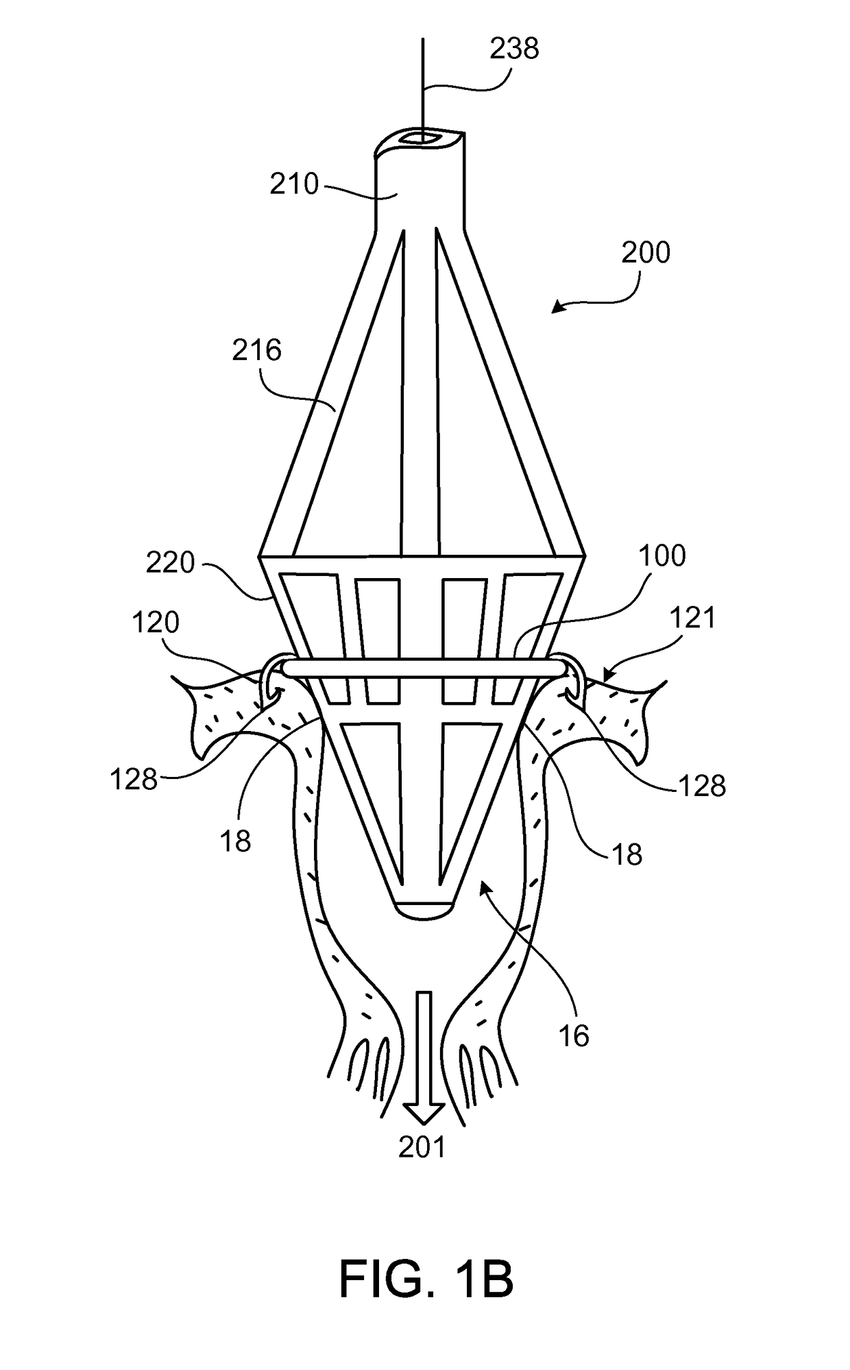 Reconfiguring tissue features of a heart annulus