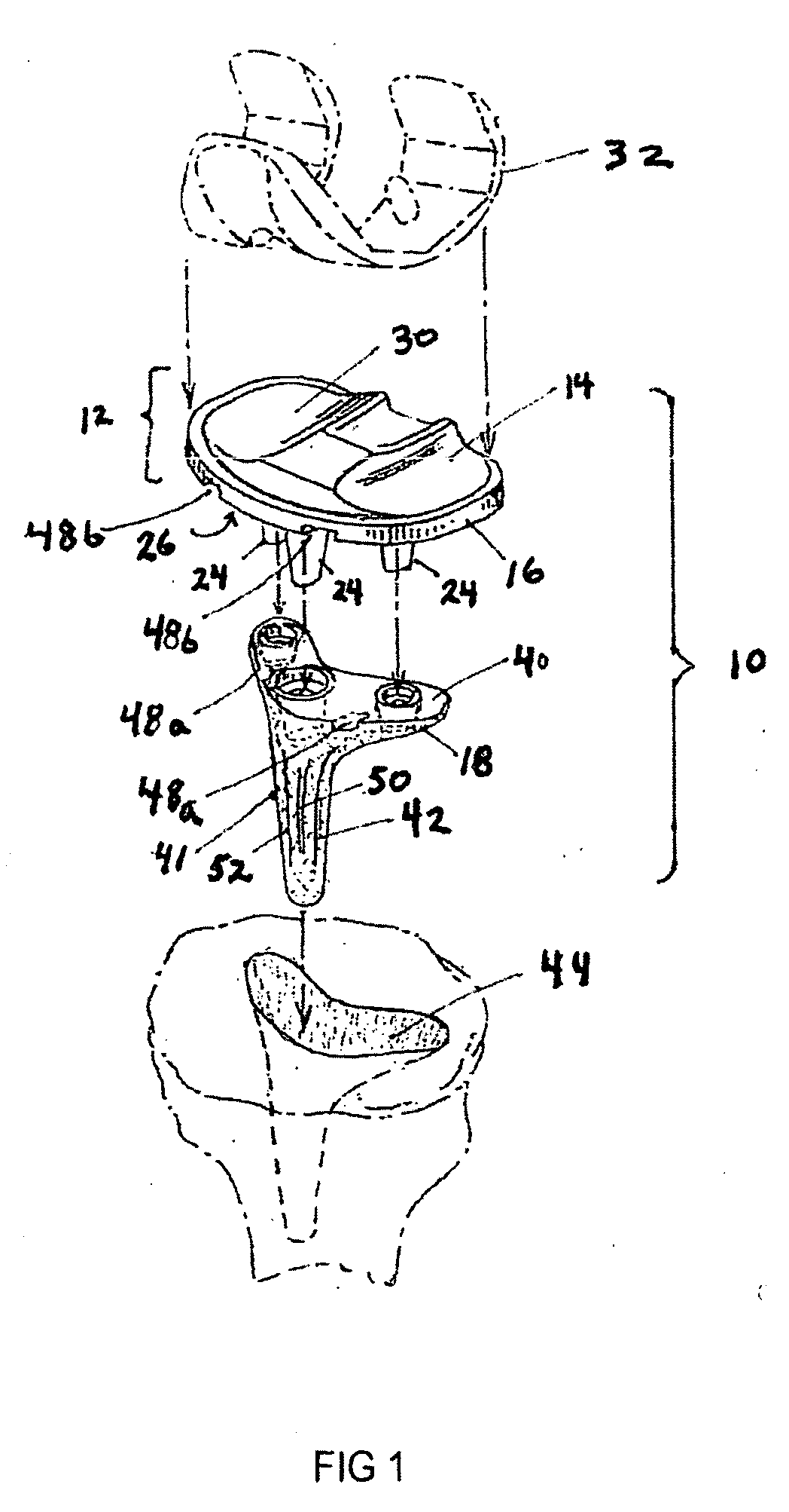 Precision Total Knee Arthroplasty