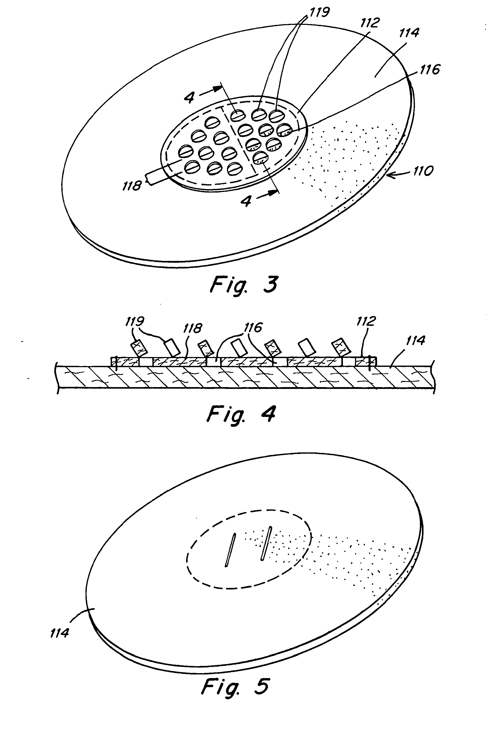 Implantable prosthesis