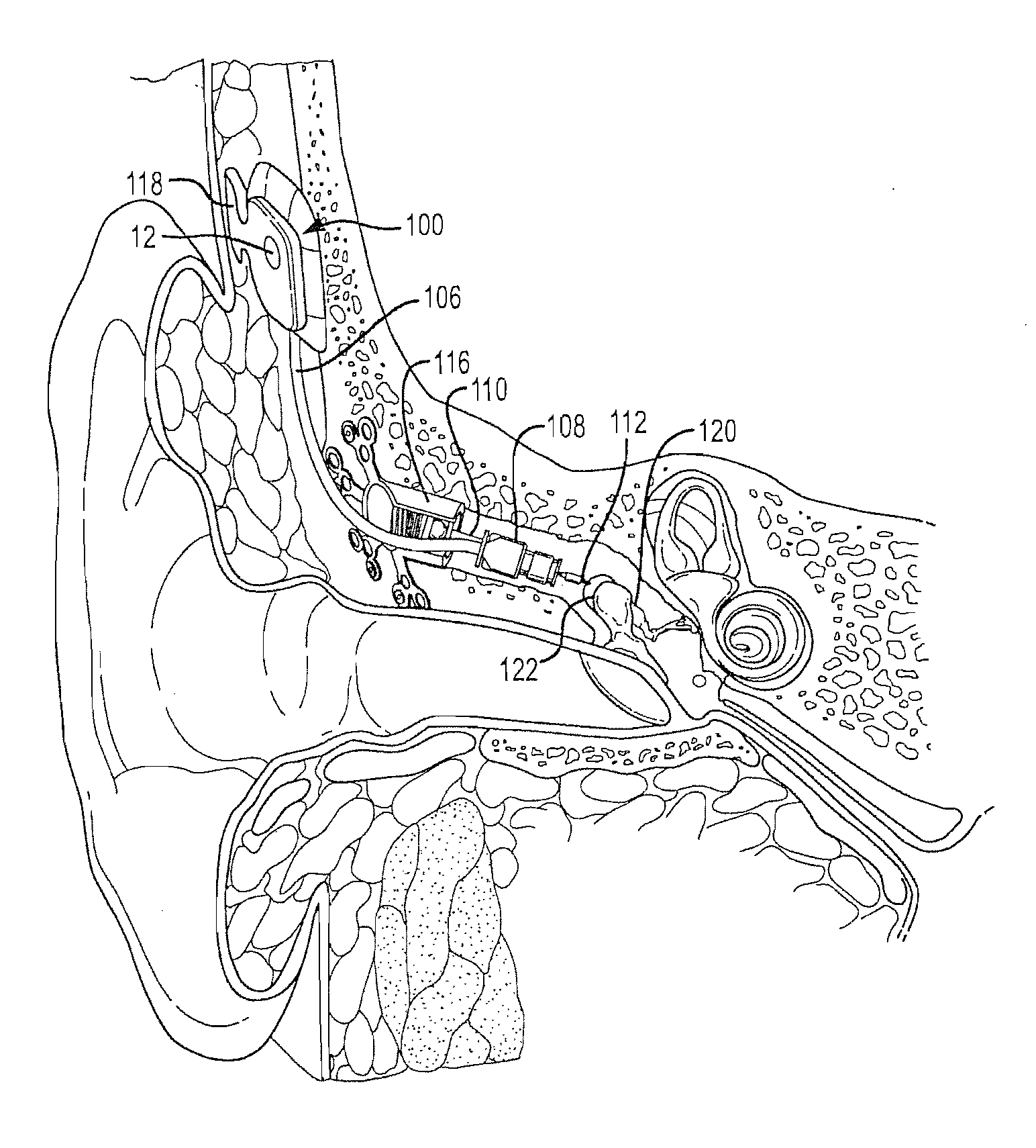 Adaptive cancellation system for implantable hearing instruments