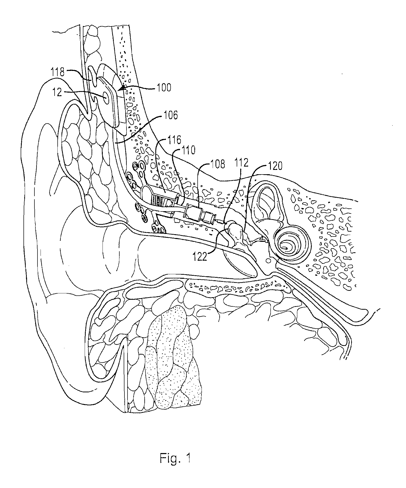 Adaptive cancellation system for implantable hearing instruments