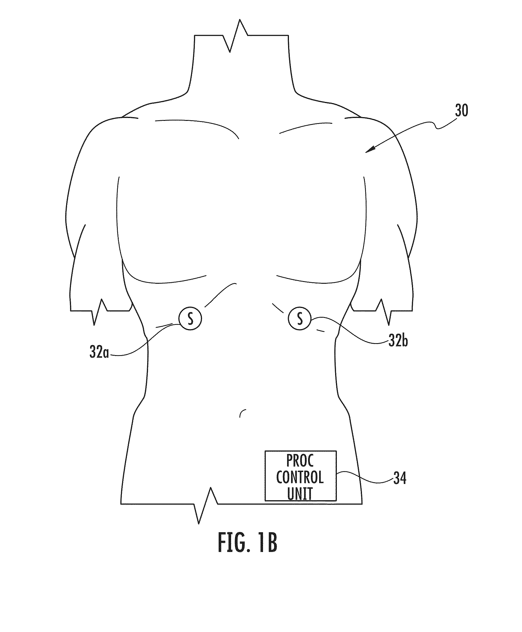 Urinary catheter system for diagnosing a physiological abnormality such as stress urinary incontinence