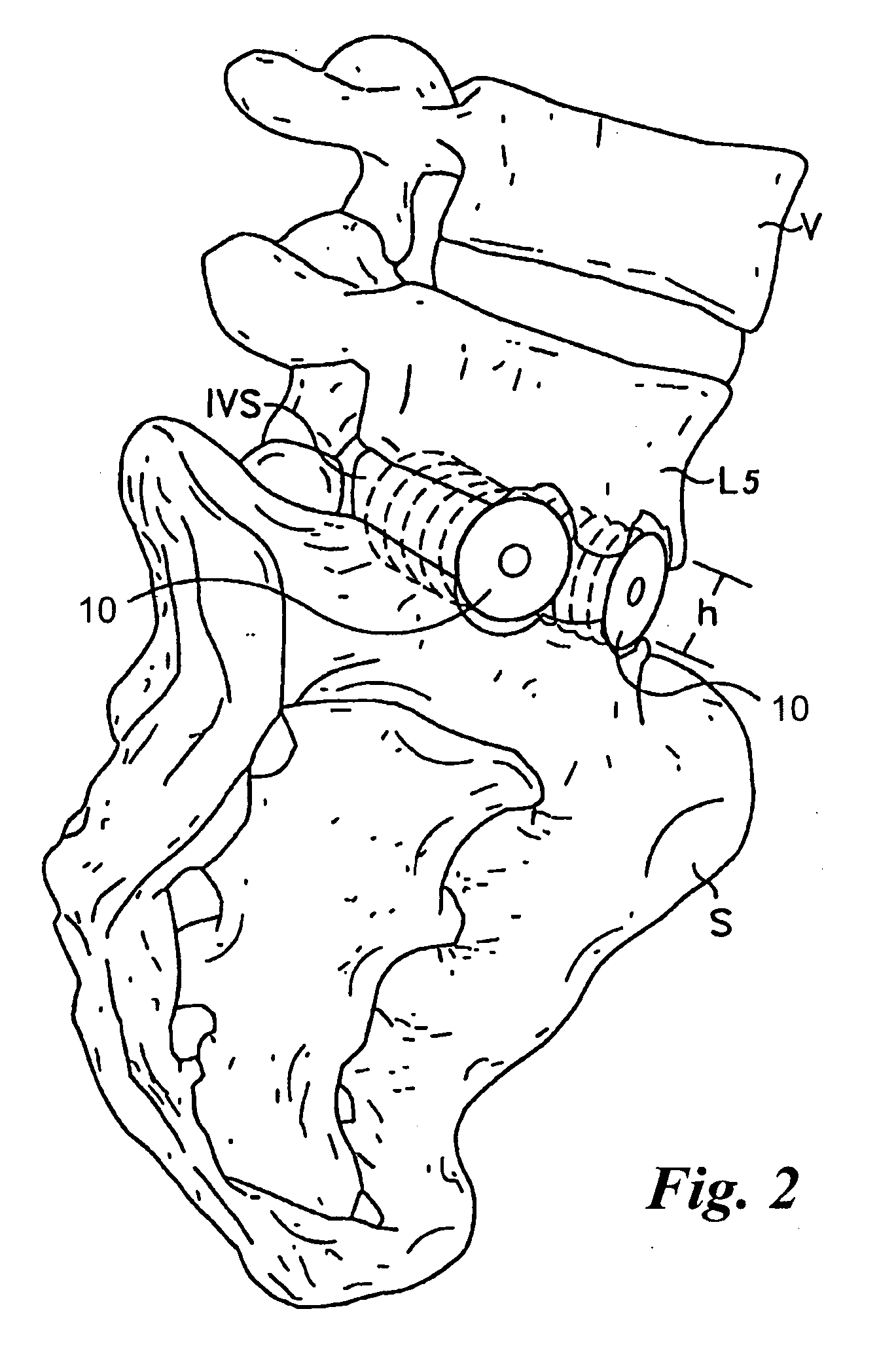 Bone grafts