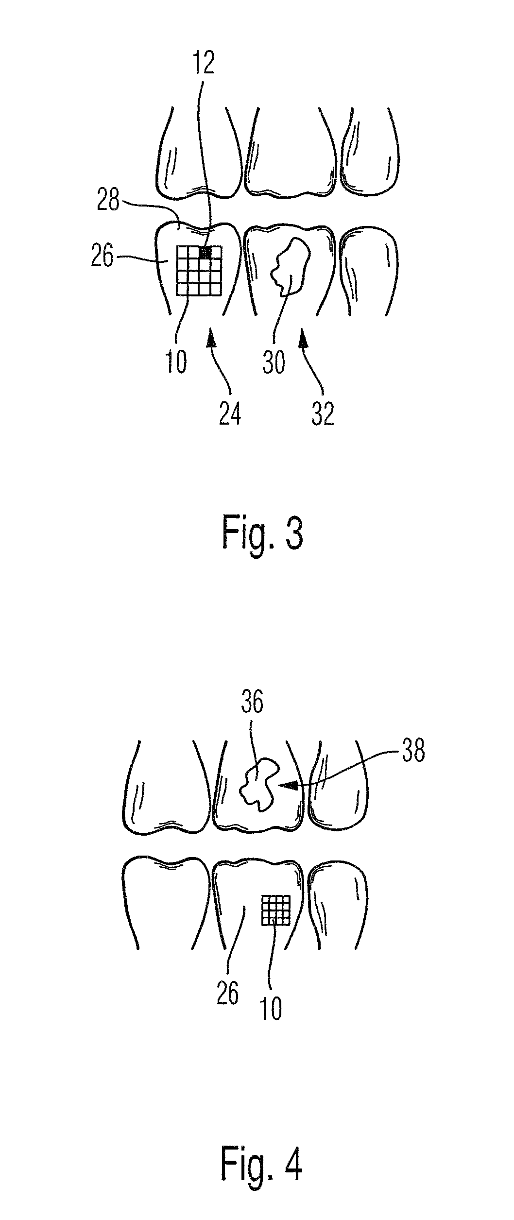 Dental color analyzing device and methof of use