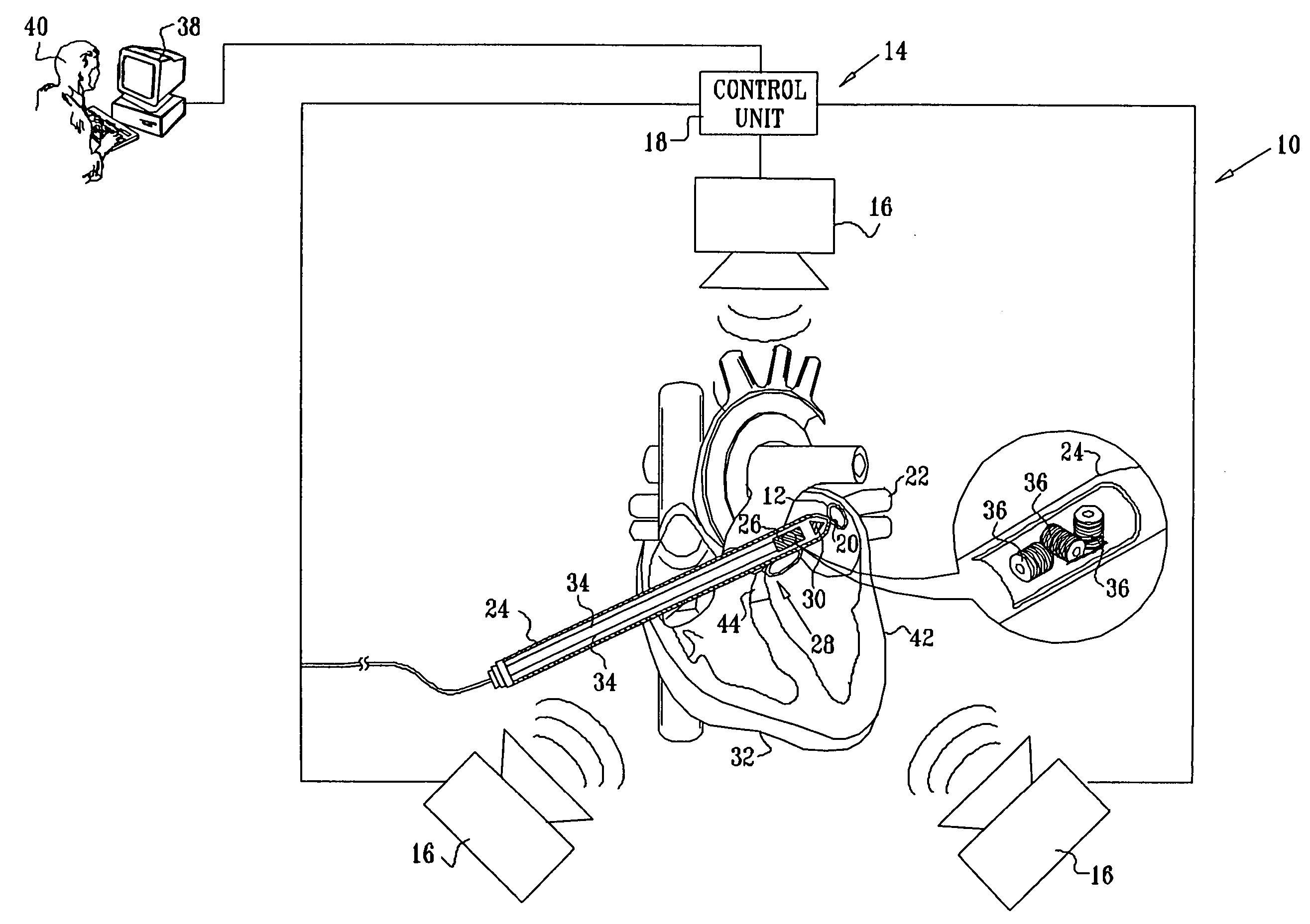 Externally applied RF for pulmonary vein isolation