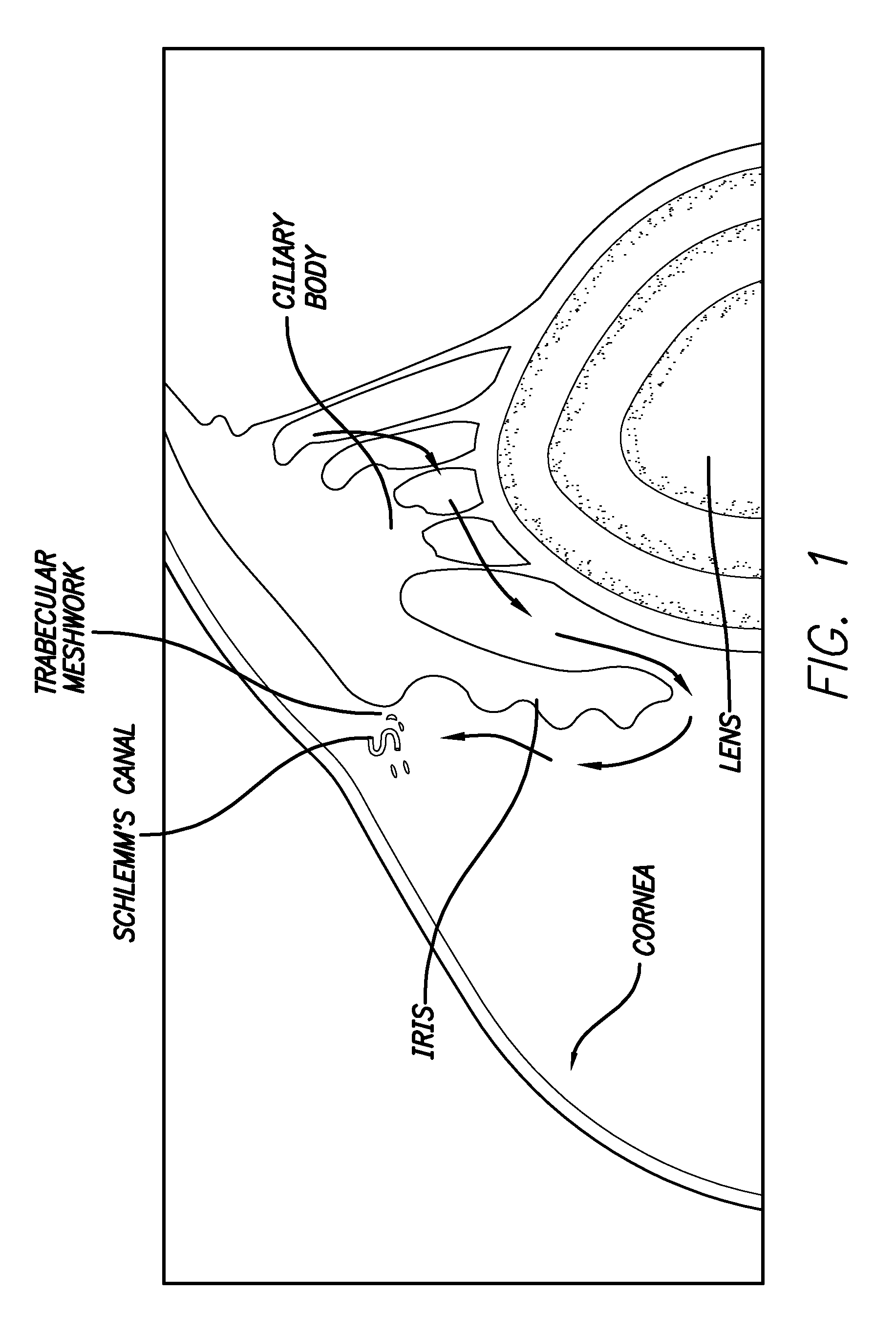 Ultrasonic treatment of glaucoma