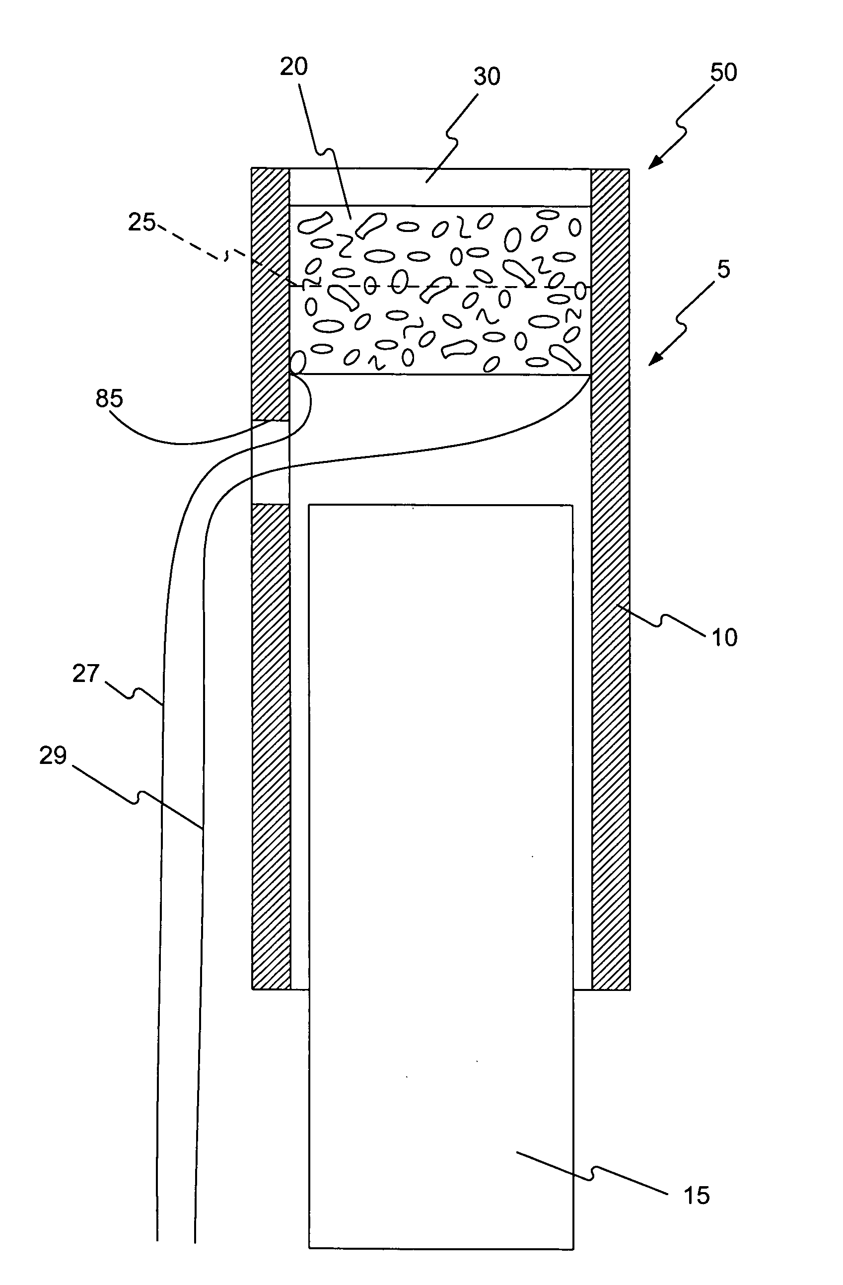 Device to aid in stone removal and laser lithotripsy