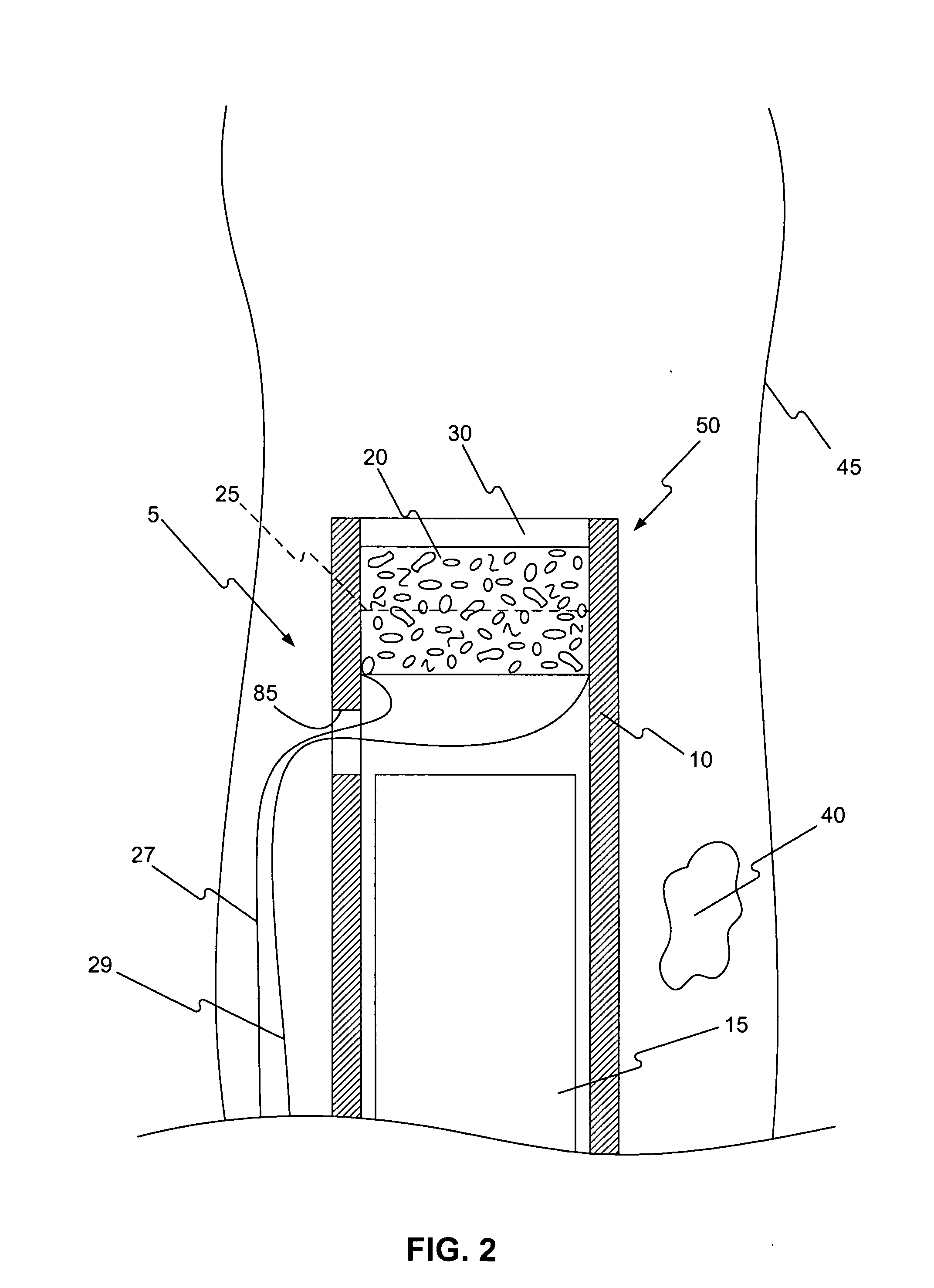 Device to aid in stone removal and laser lithotripsy