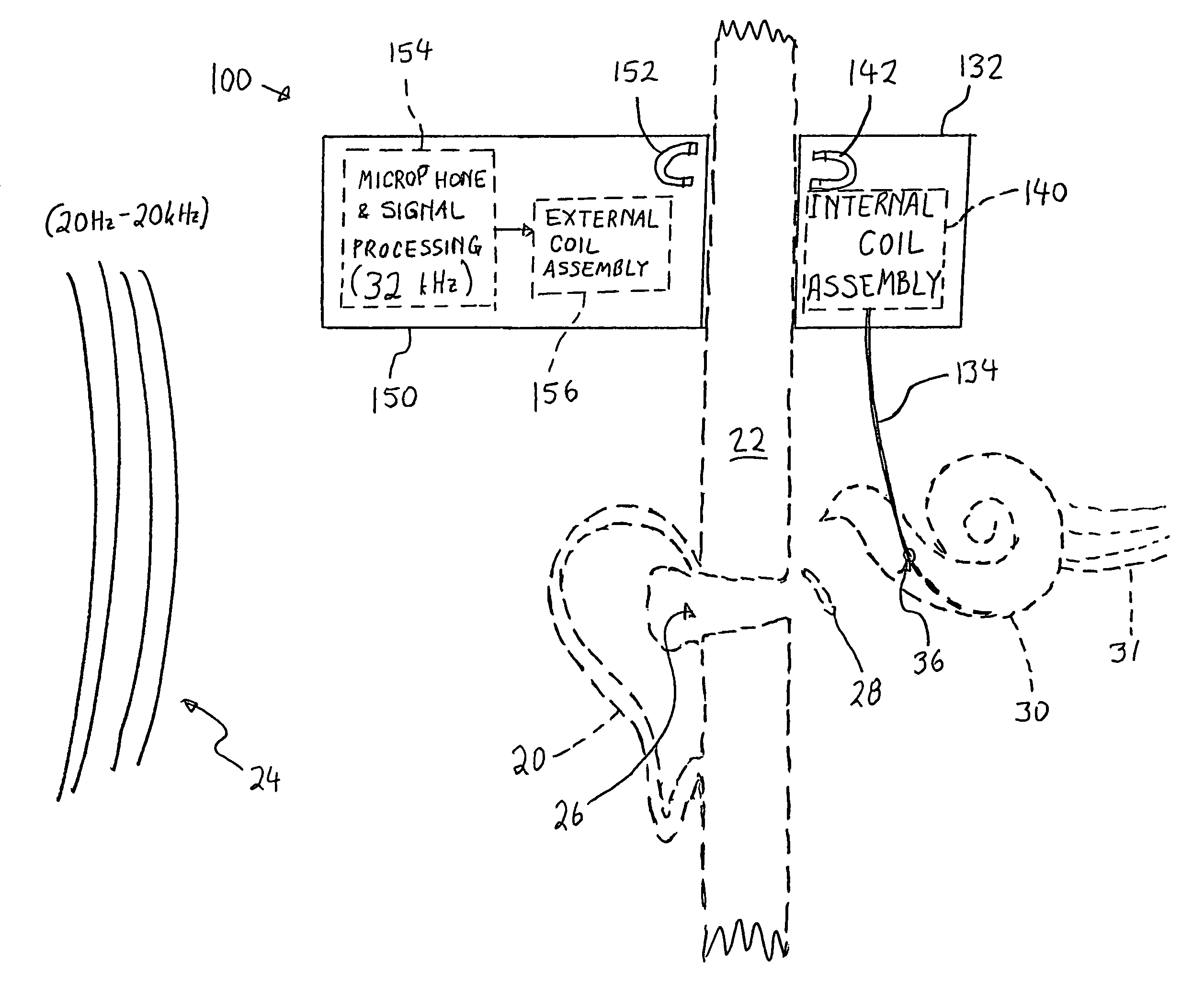 Cochlear implants with a stimulus in the human ultrasonic range and method for stimulating a cochlea