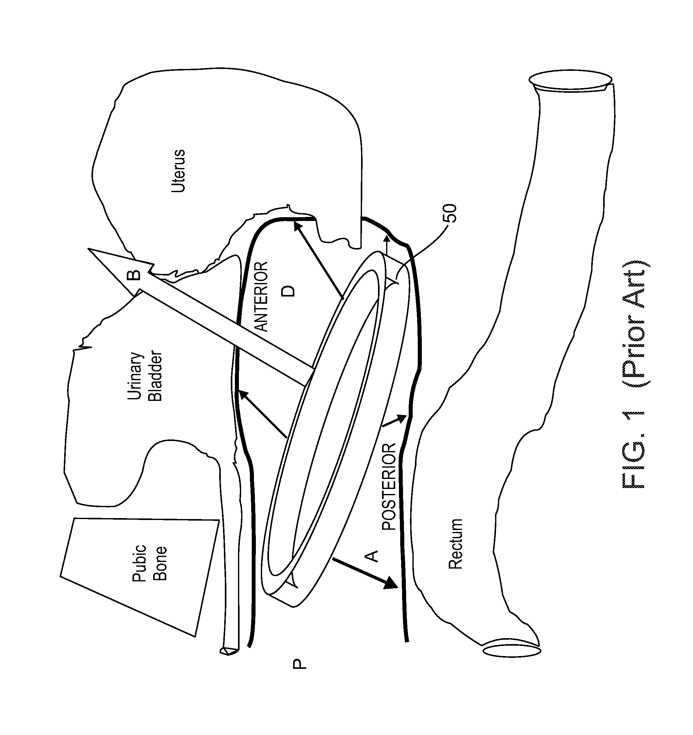 Vaginal carrier for the controlled release of substances