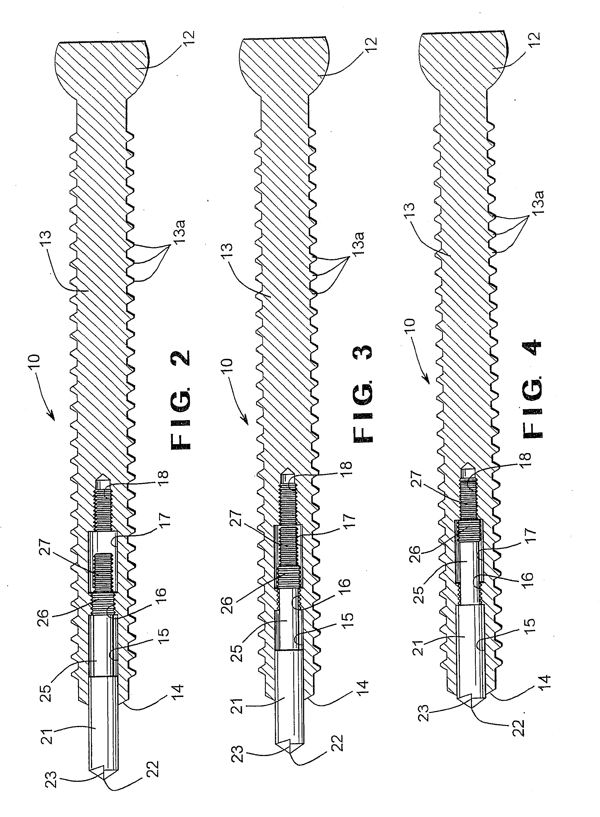 Pedicle screw assembly having a retractable screw tip for facilitating the securement of the pedicle screw assembly to a spinal vertebra