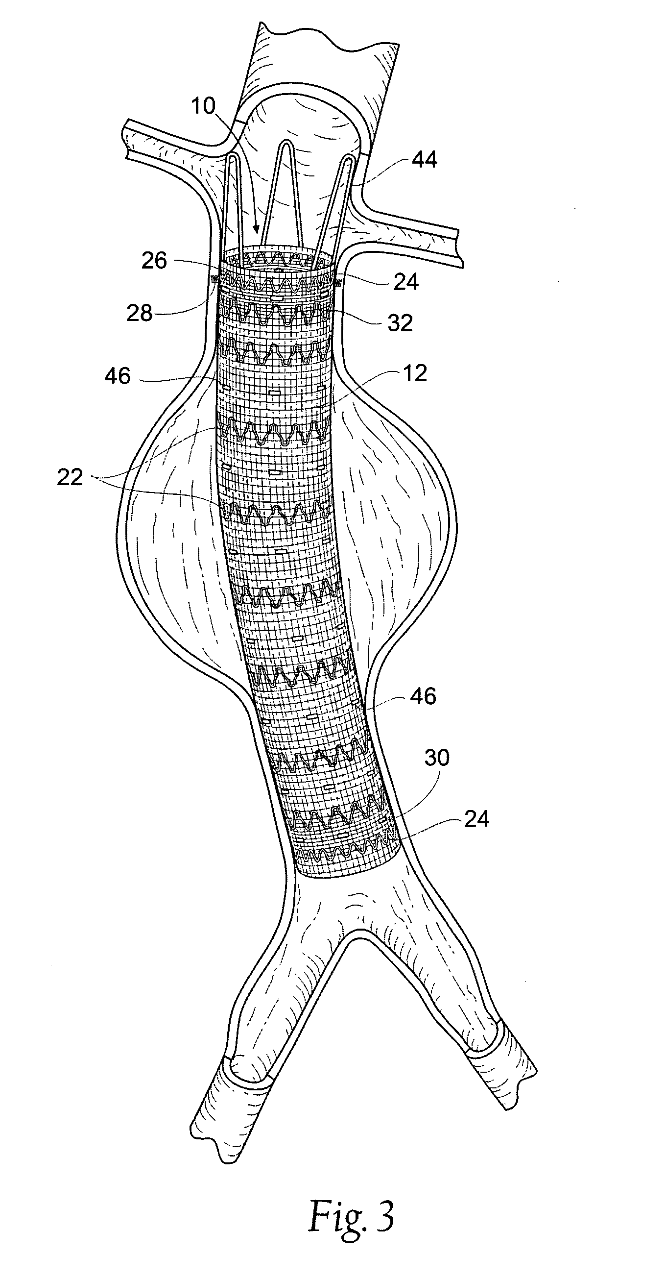 Systems and methods for attaching a prosthesis within a body lumen or hollow organ