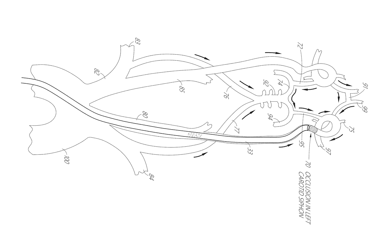 Enhanced flexibility neurovascular catheter with tensile support